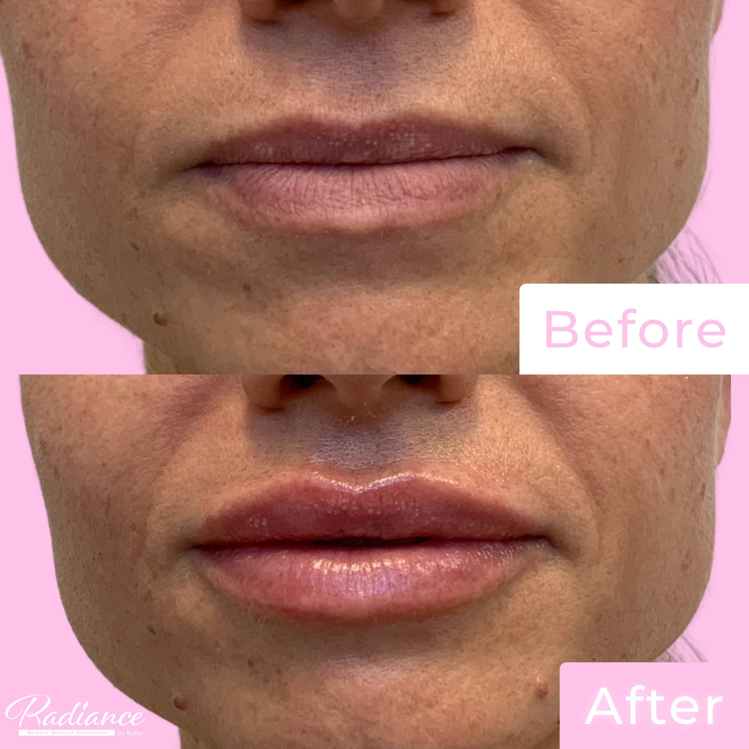 Fillers Before & After Gallery - Patient 12504 - Image 1