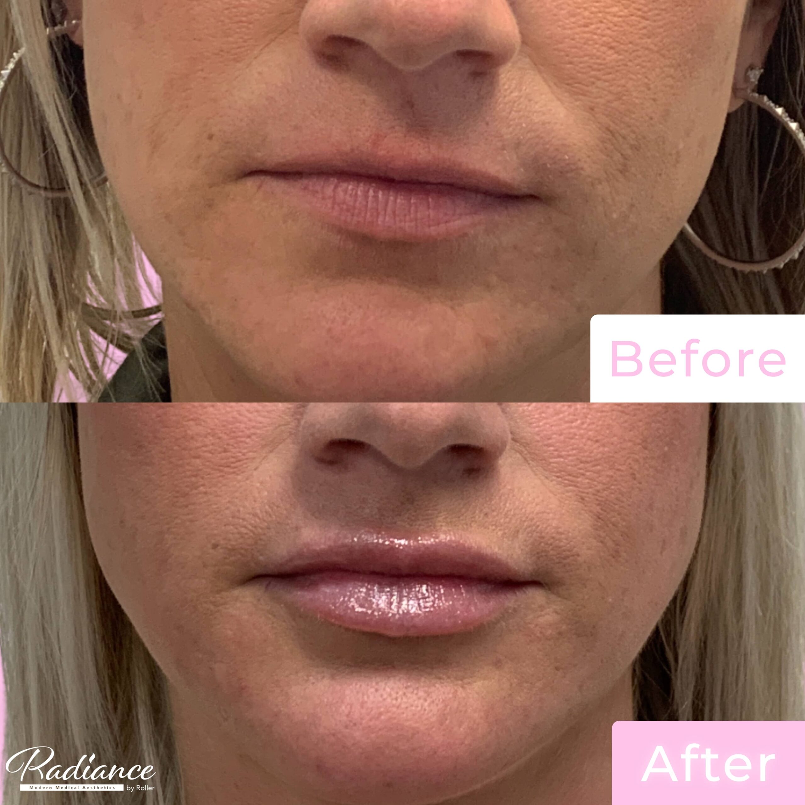 Fillers Before & After Gallery - Patient 12501 - Image 1