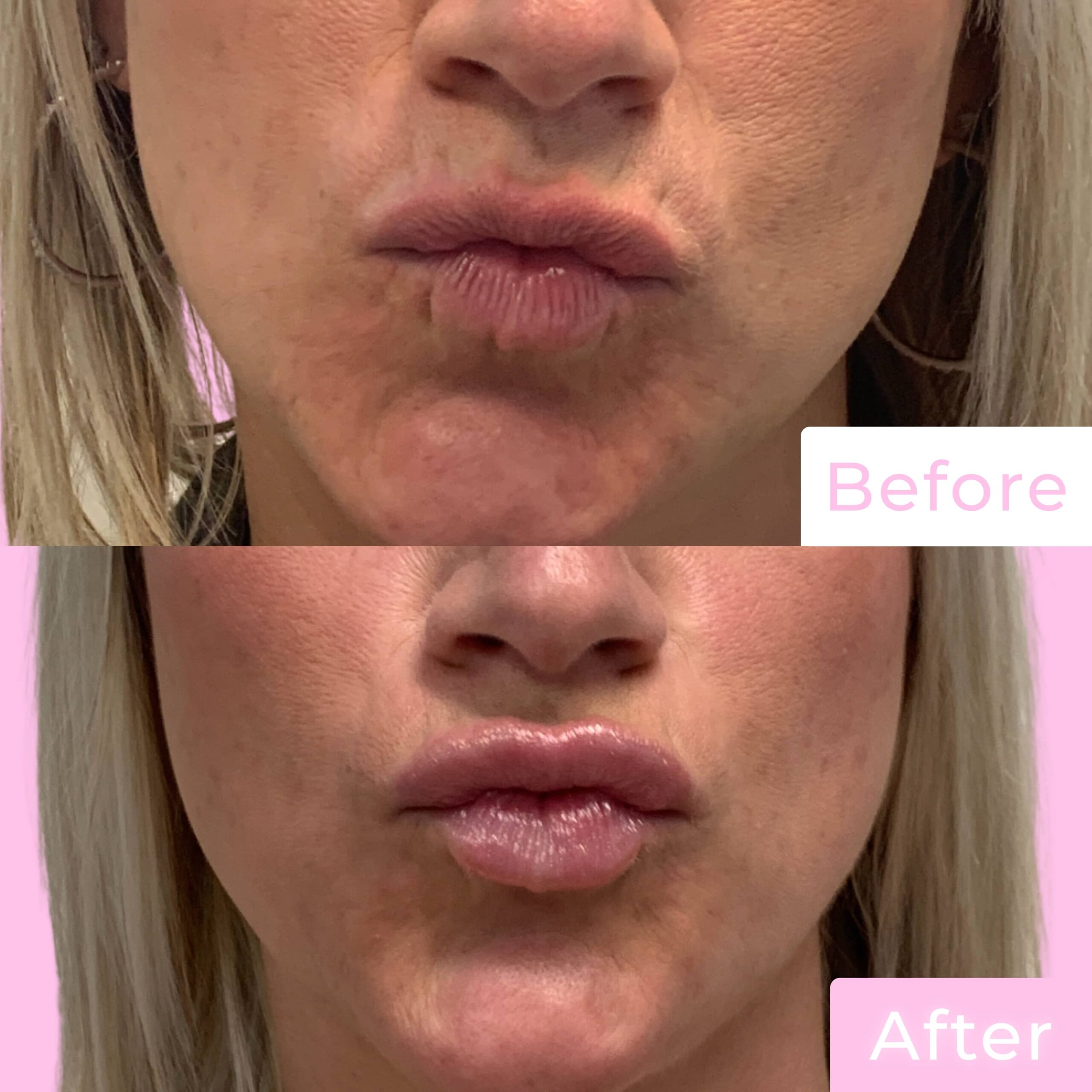 Fillers Before & After Gallery - Patient 12501 - Image 2