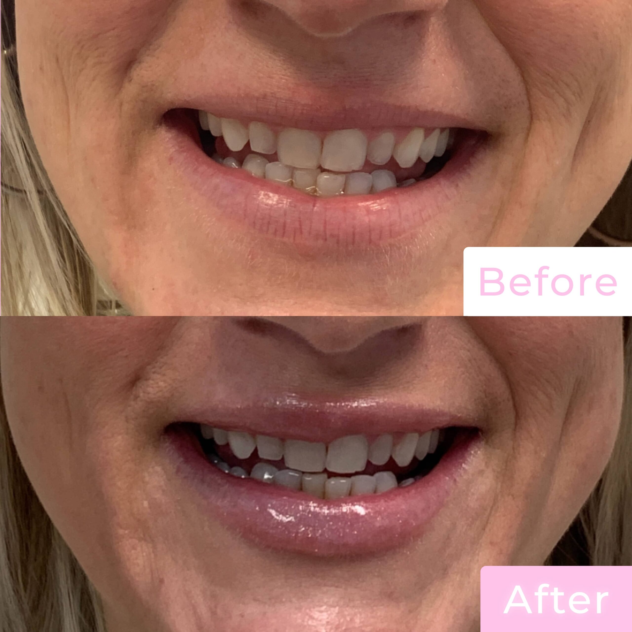 Fillers Before & After Gallery - Patient 12501 - Image 3
