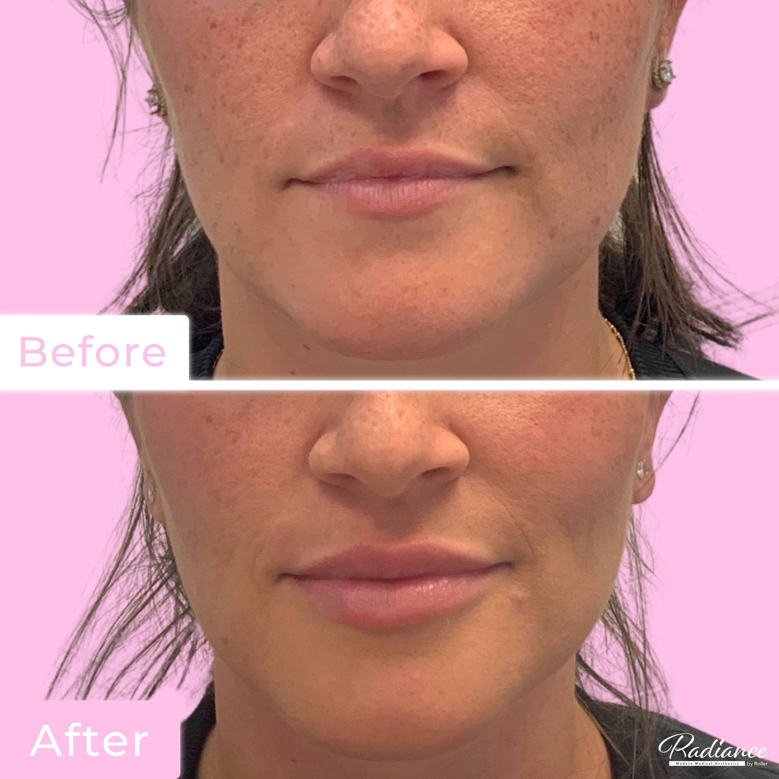 Fillers Before & After Gallery - Patient 12499 - Image 1