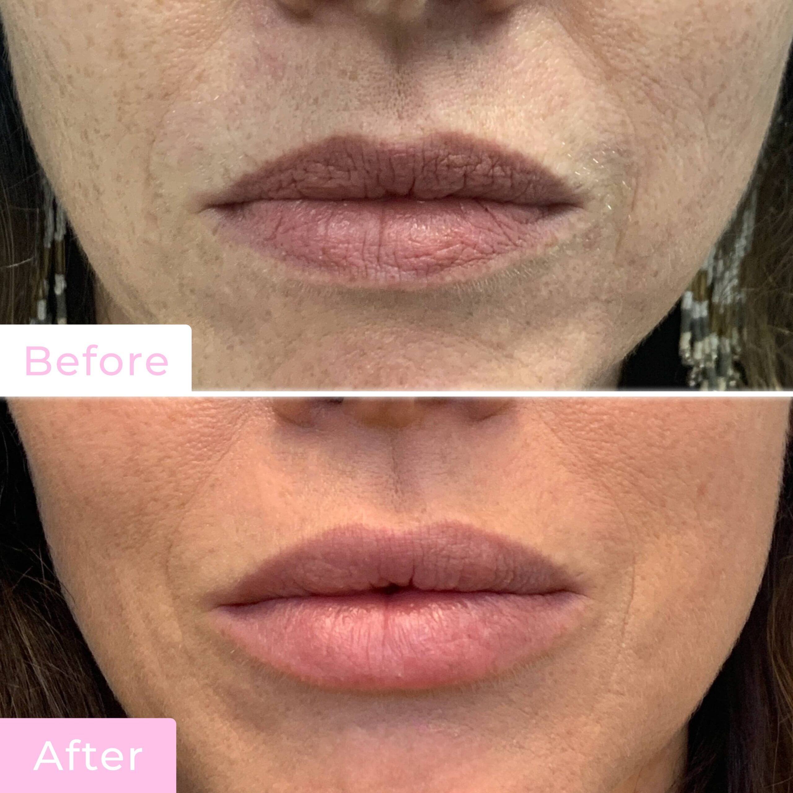 Fillers Before & After Gallery - Patient 12493 - Image 1
