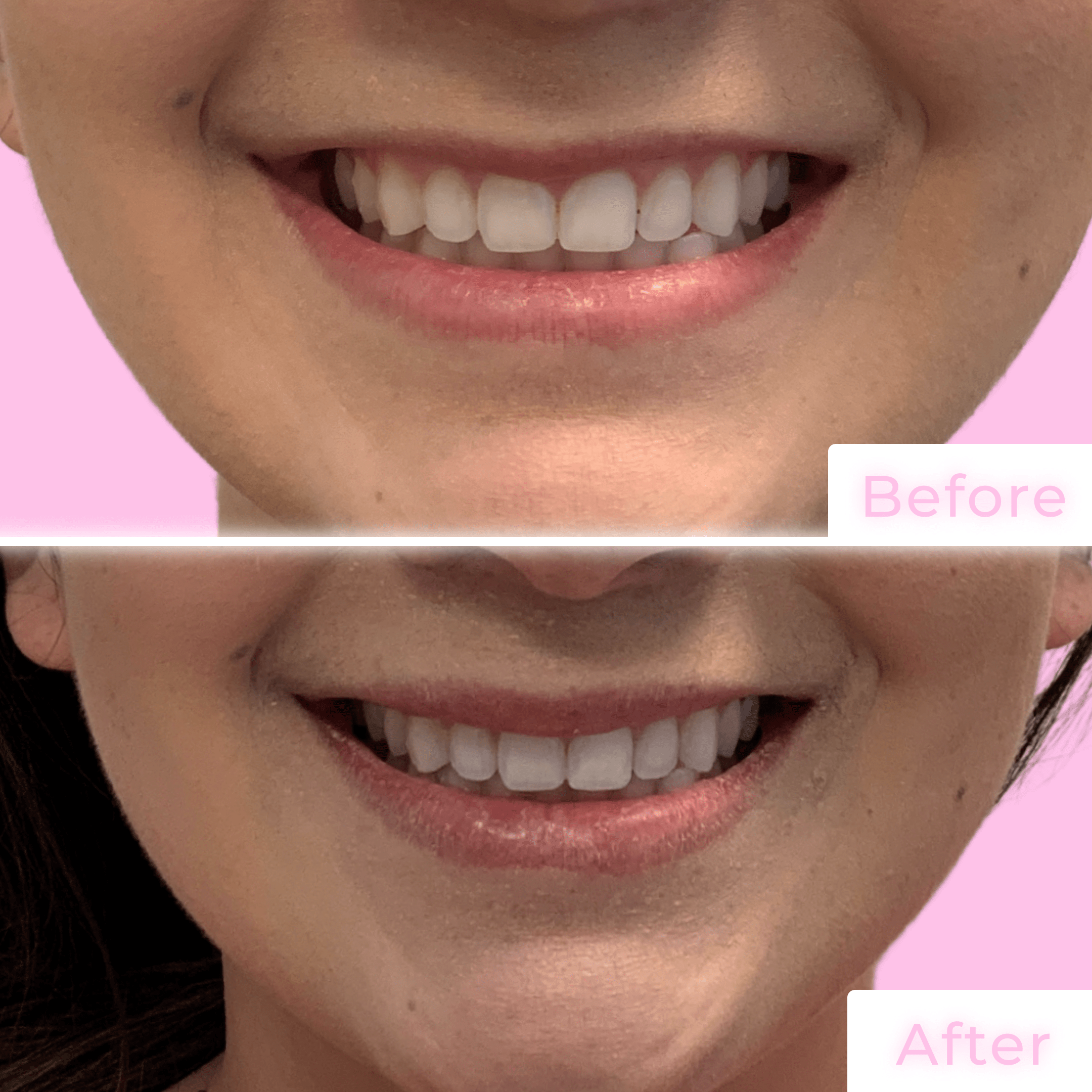 Fillers Before & After Gallery - Patient 12493 - Image 2