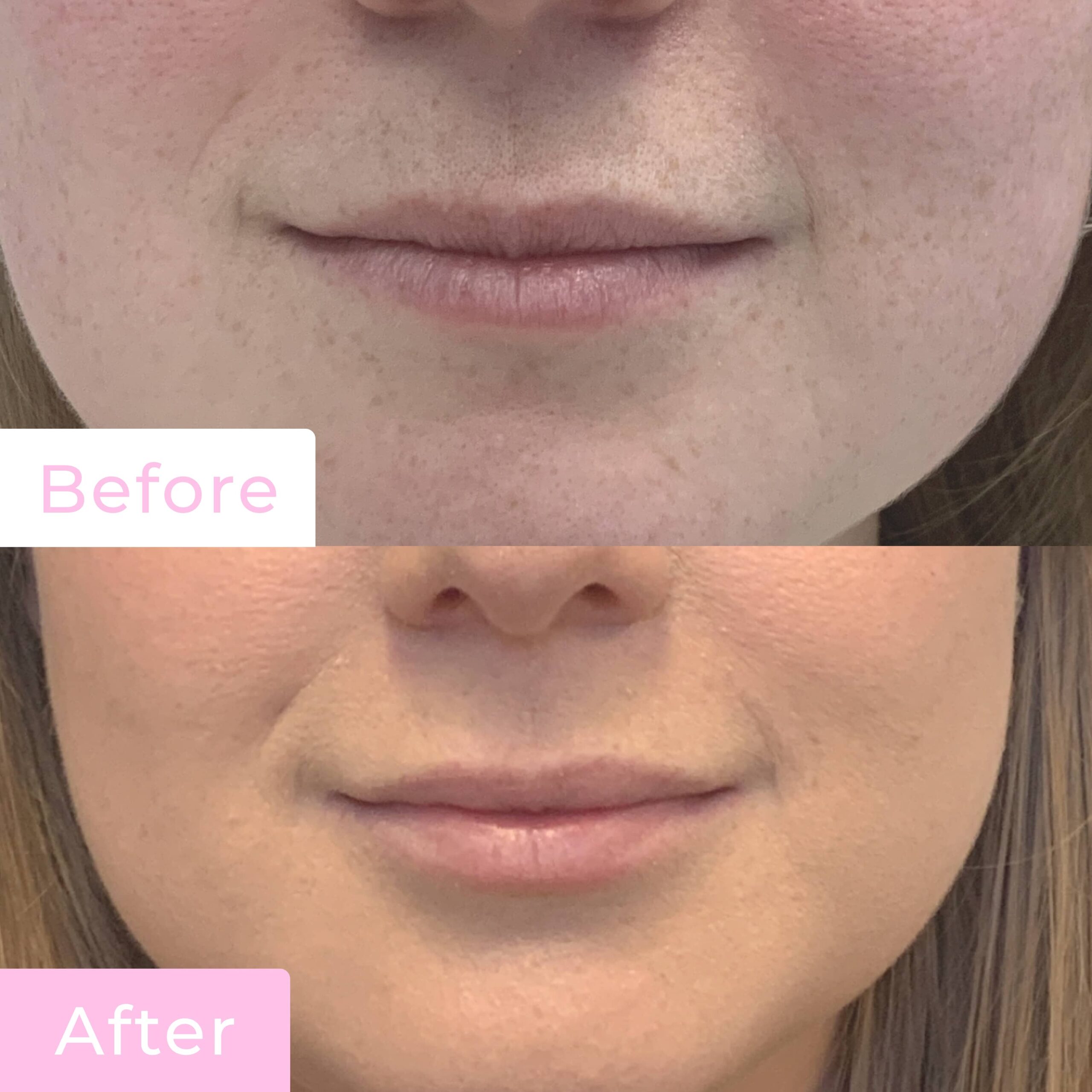 Fillers Before & After Gallery - Patient 12496 - Image 1