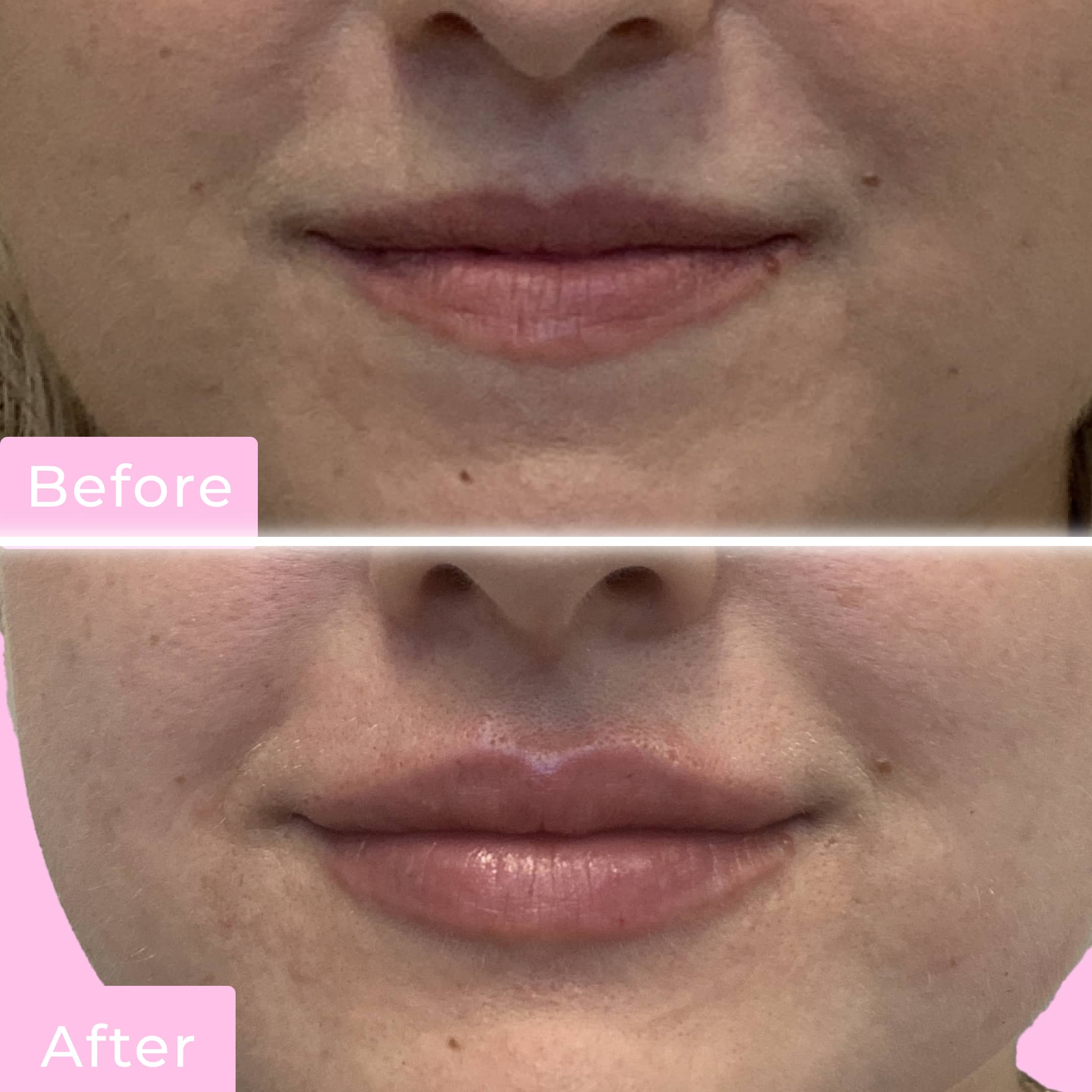Lip Flip Before & After Gallery - Patient 12678 - Image 1