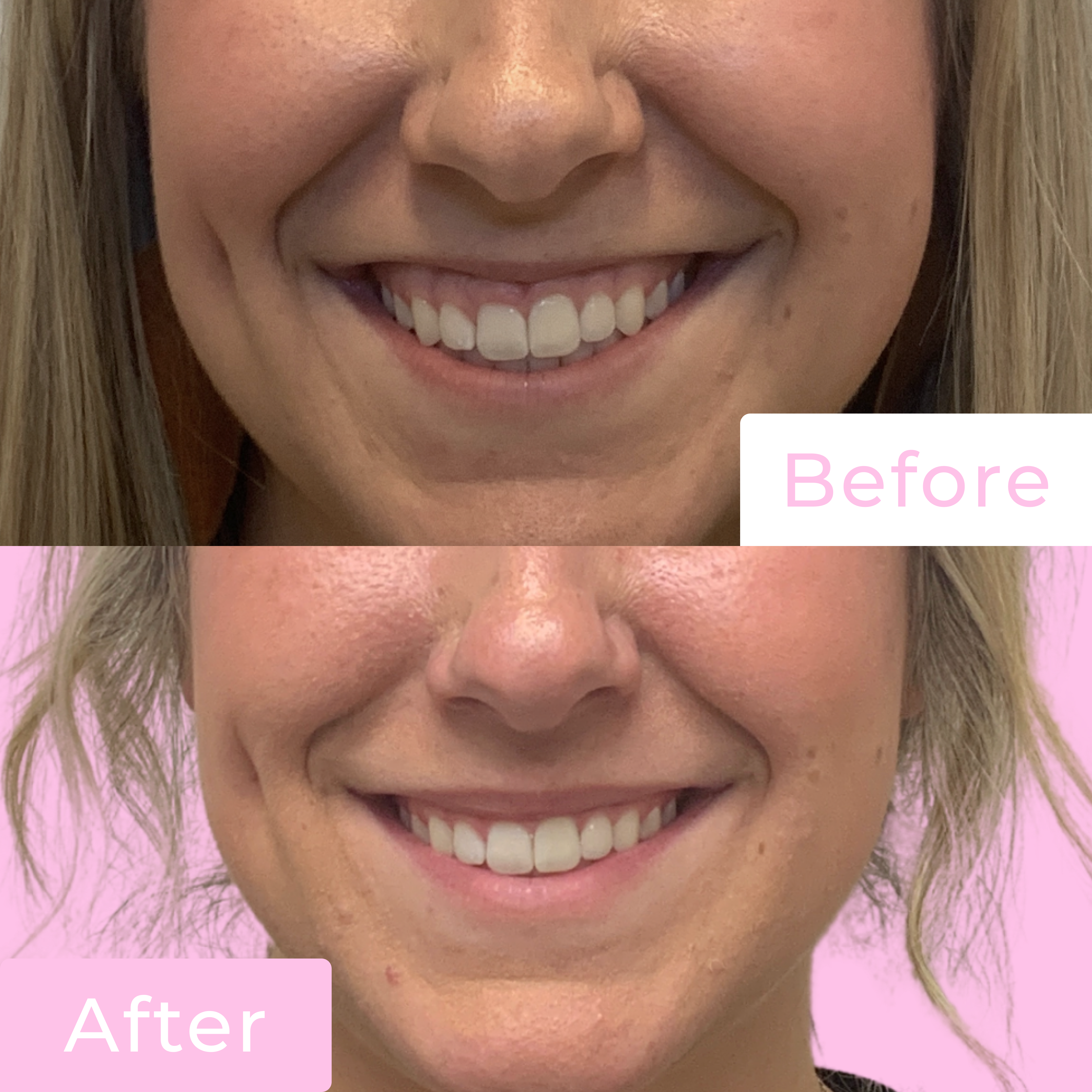 Lip Flip Before & After Gallery - Patient 12677 - Image 1