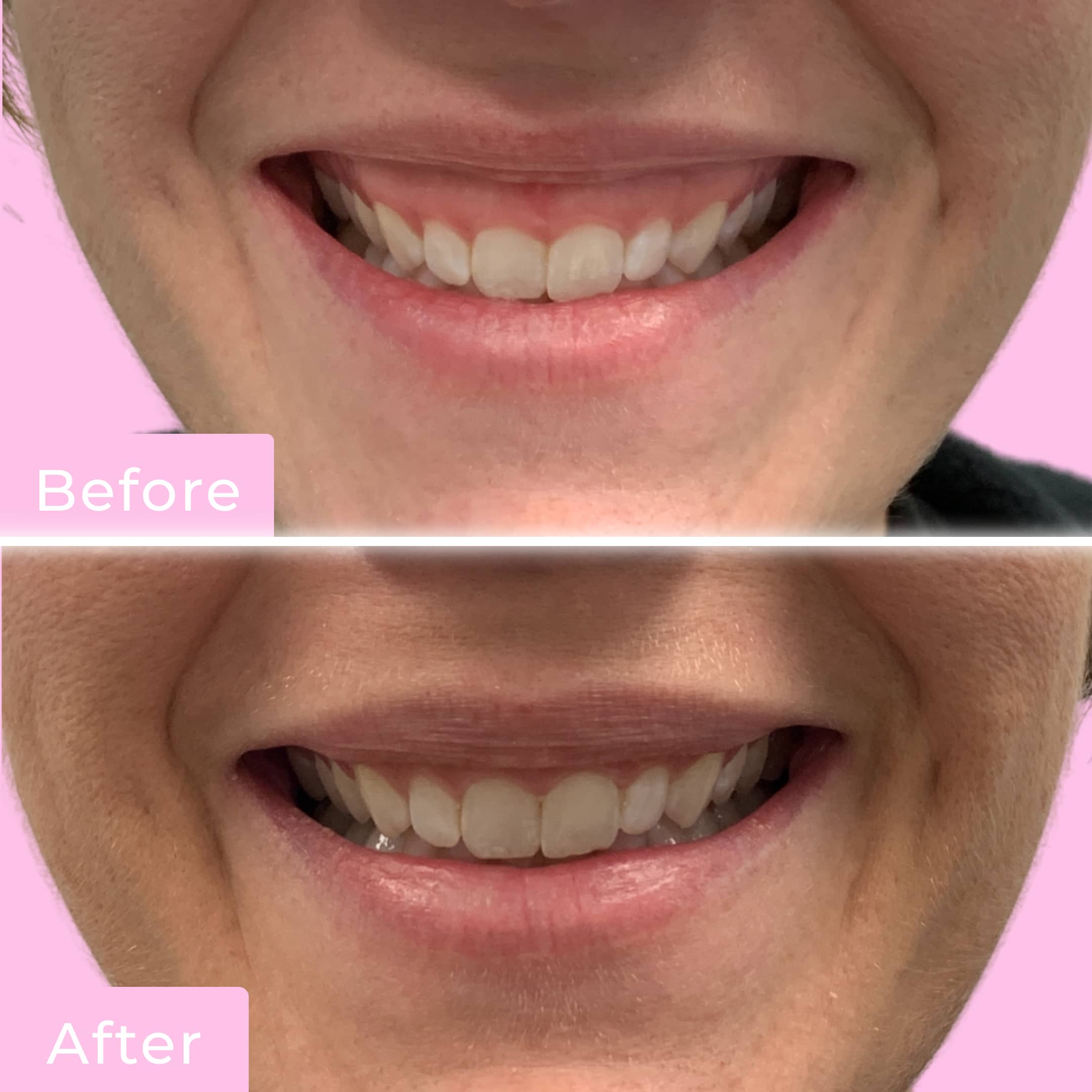 Lip Flip Before & After Gallery - Patient 12672 - Image 1