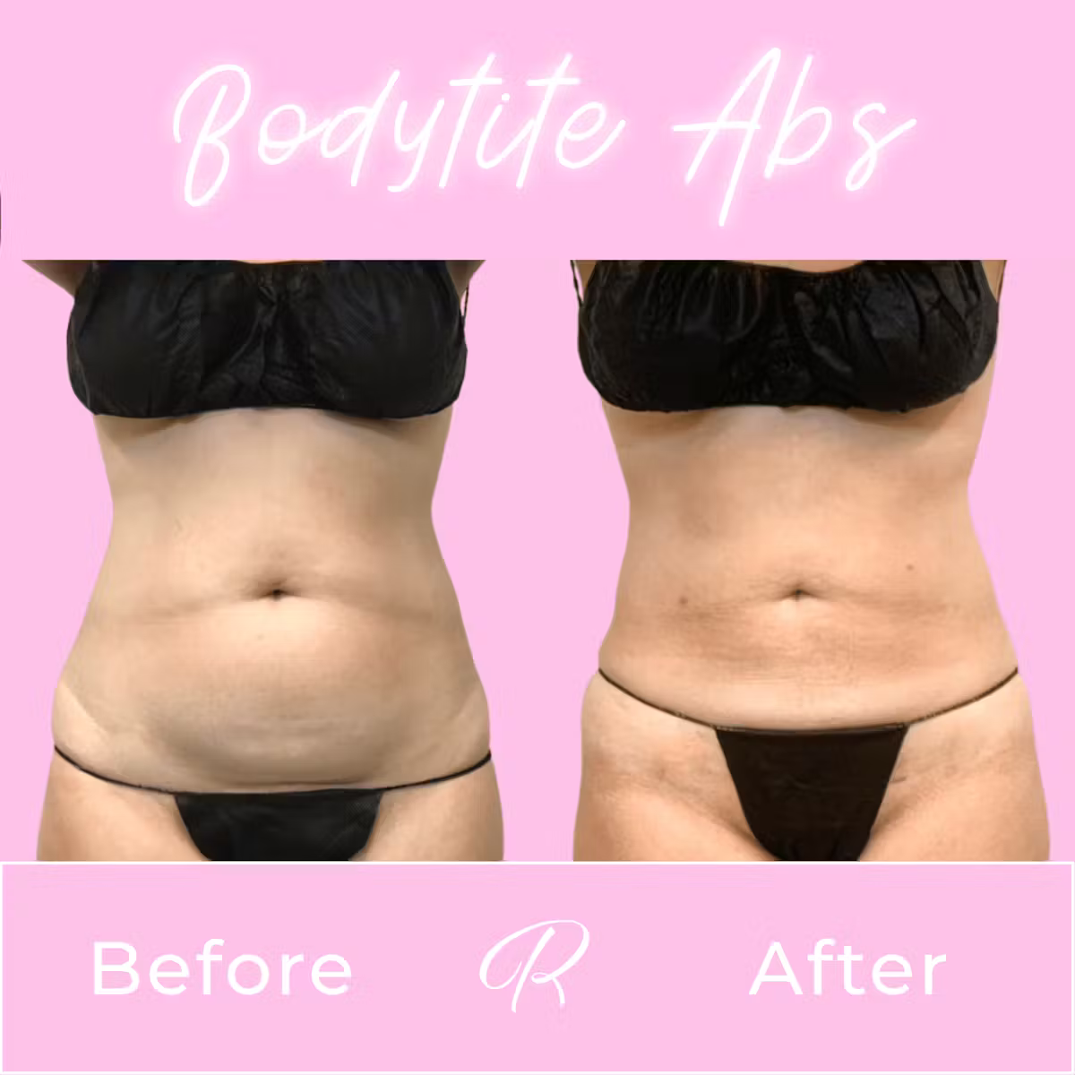 BodyTite Before & After Gallery - Patient 13203 - Image 1