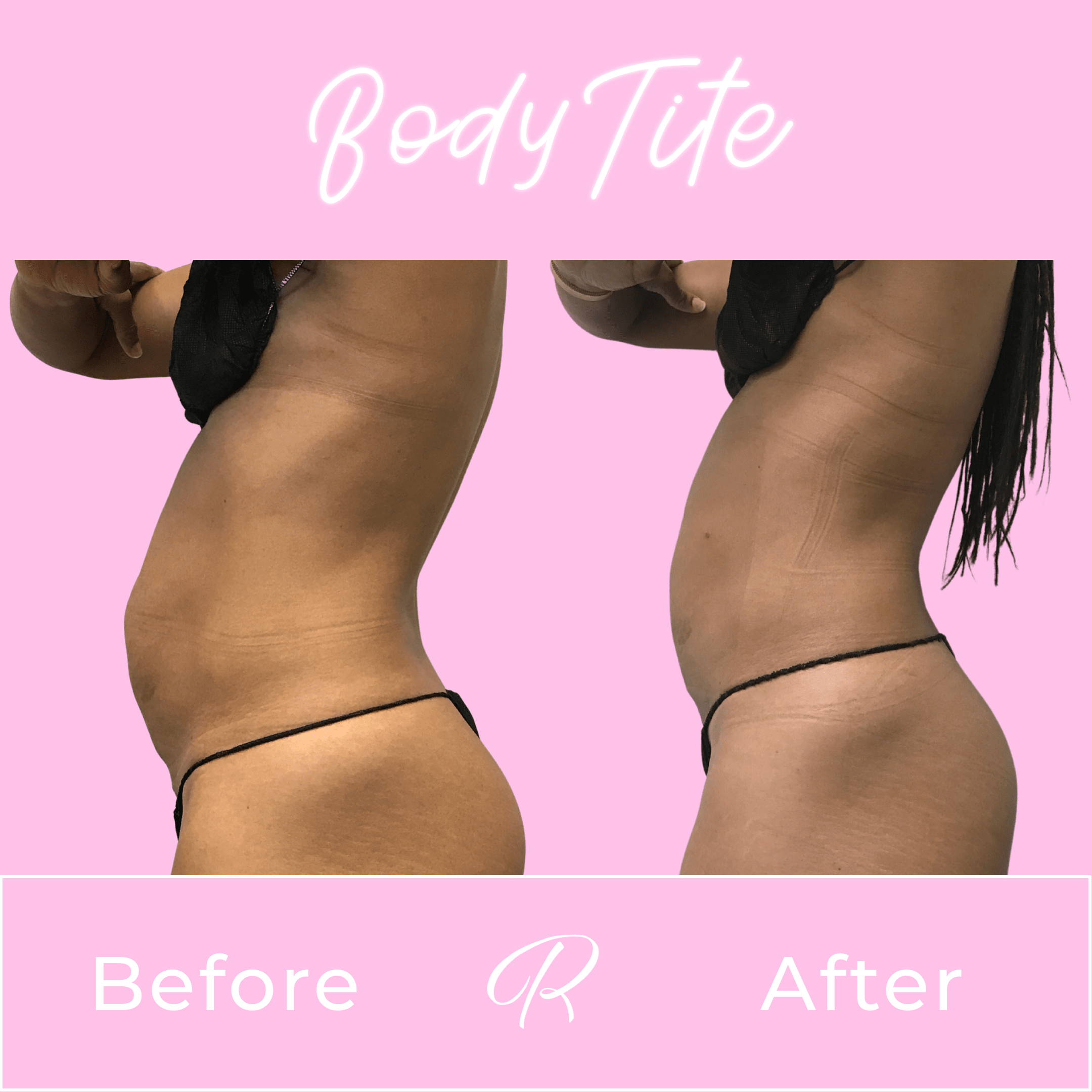 BodyTite Before & After Gallery - Patient 13201 - Image 1