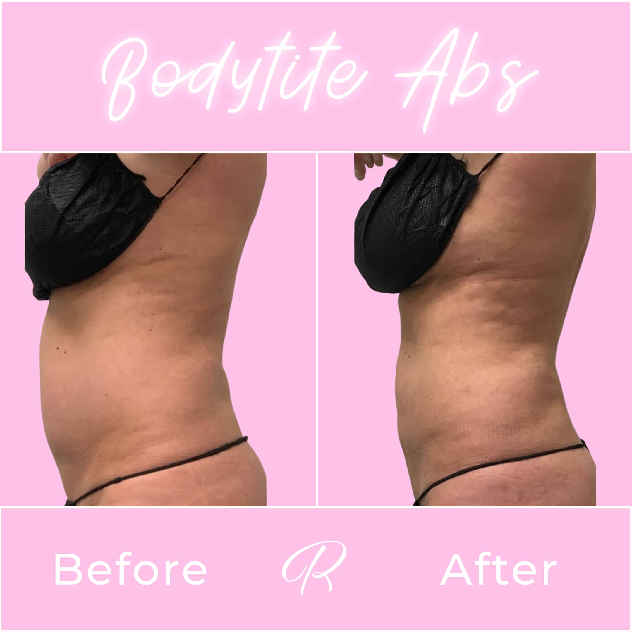 BodyTite Before & After Gallery - Patient 13199 - Image 1