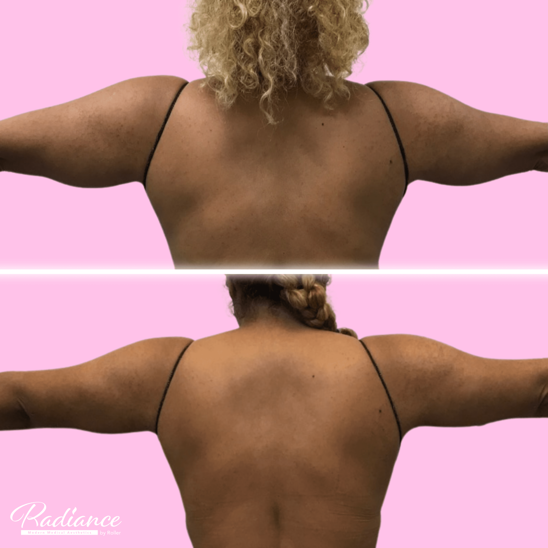 BodyTite Before & After Gallery - Patient 13196 - Image 1