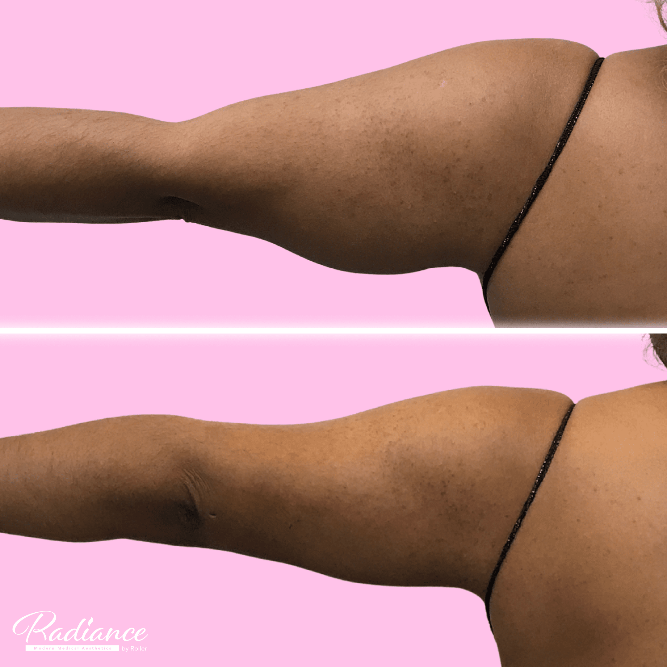 BodyTite Before & After Gallery - Patient 13196 - Image 2