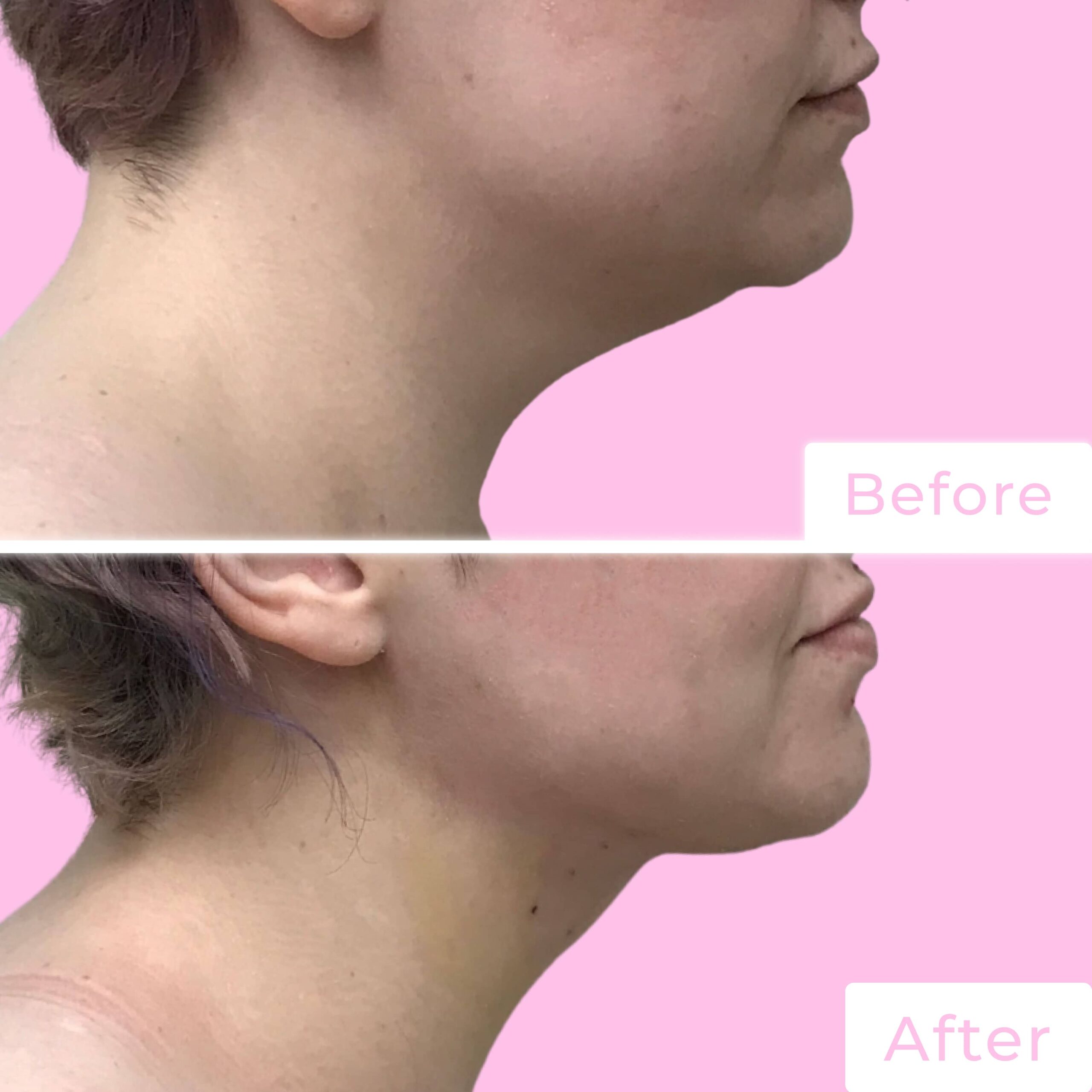 FaceTite Before & After Gallery - Patient 13211 - Image 1