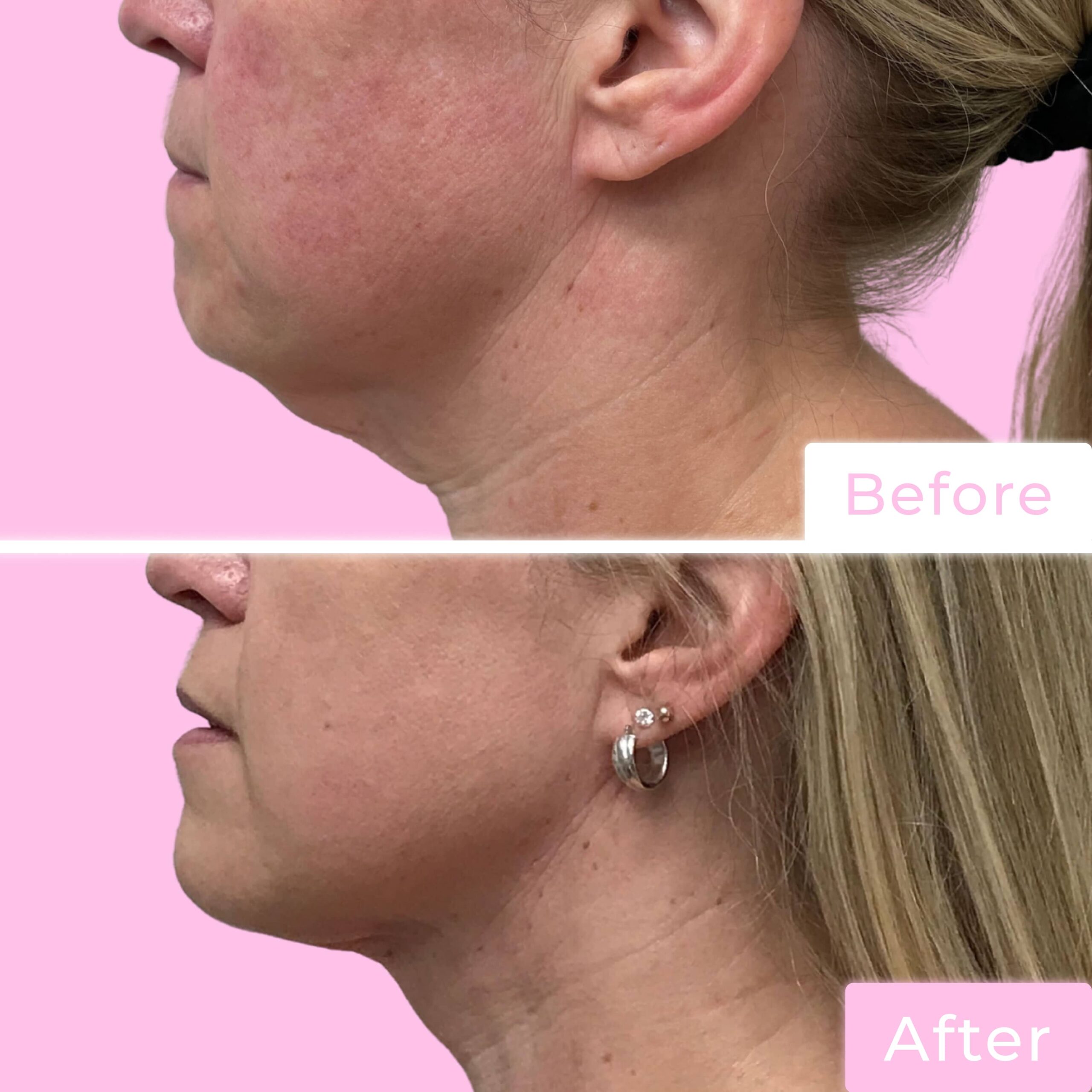 FaceTite Before & After Gallery - Patient 13209 - Image 1