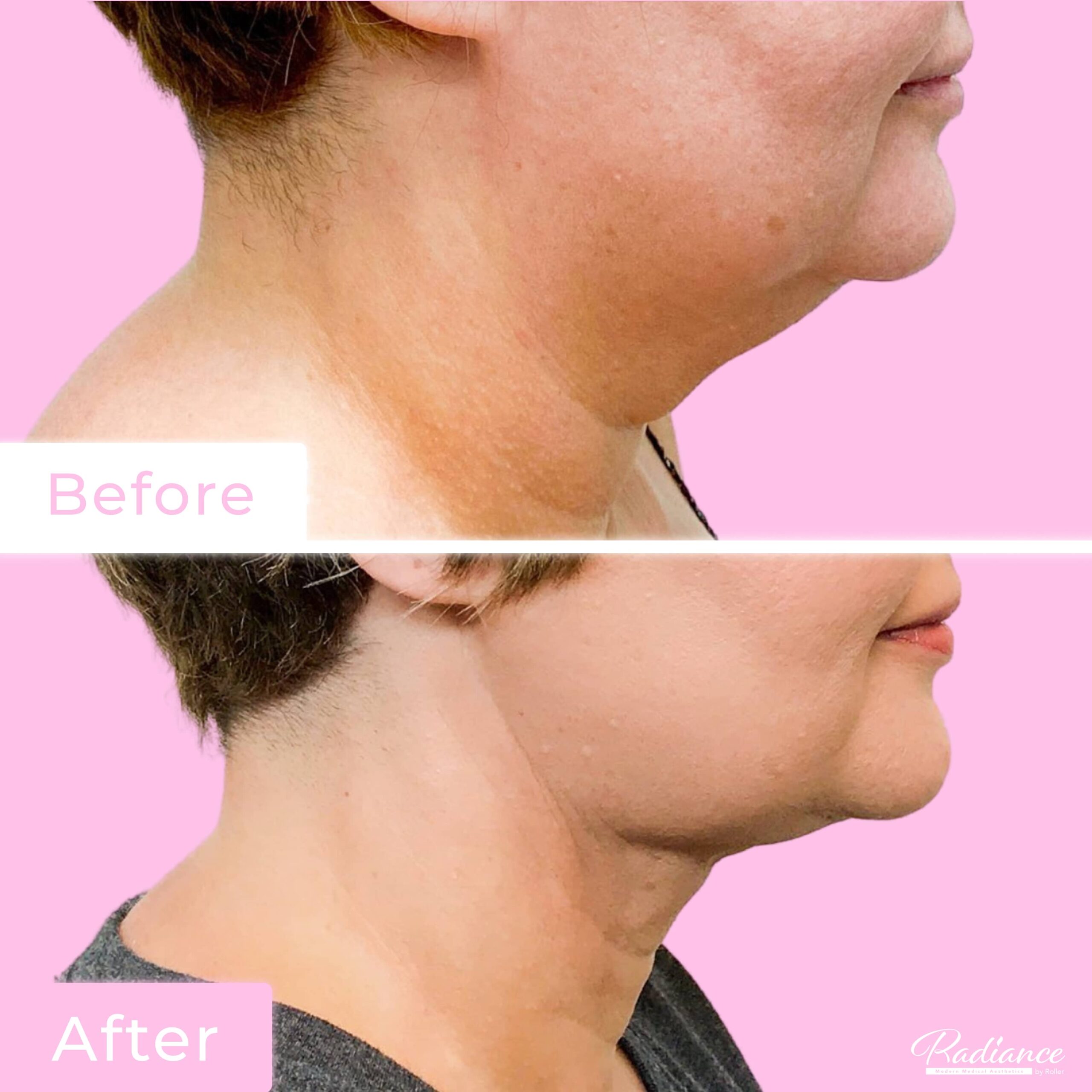 FaceTite Before & After Gallery - Patient 13205 - Image 1