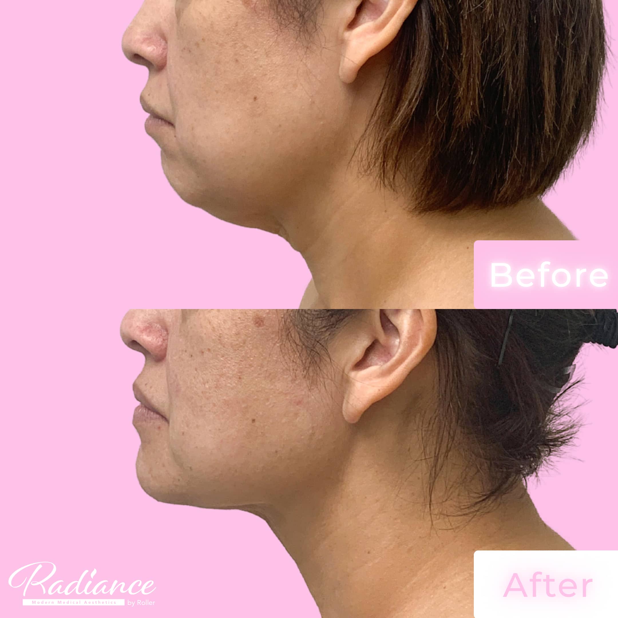 Neck Lift Before & After Gallery - Patient 13215 - Image 1
