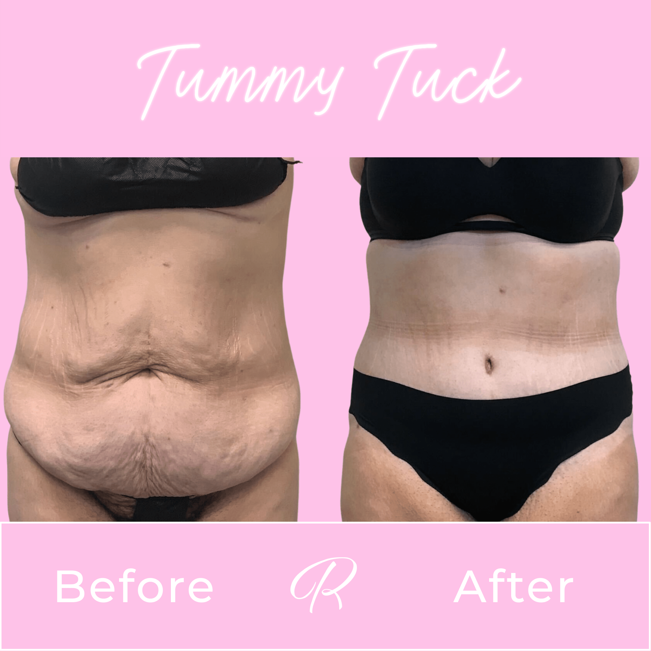 Tummy Tuck Before & After Gallery - Patient 13242 - Image 1