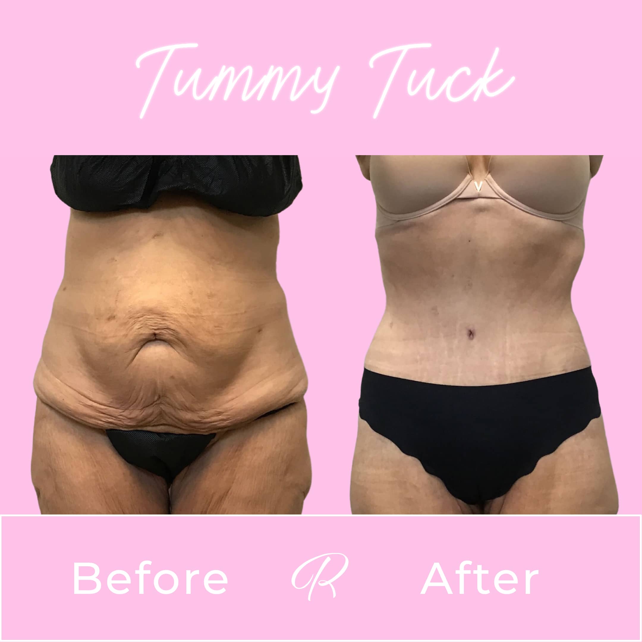 Tummy Tuck Before & After Gallery - Patient 13238 - Image 1