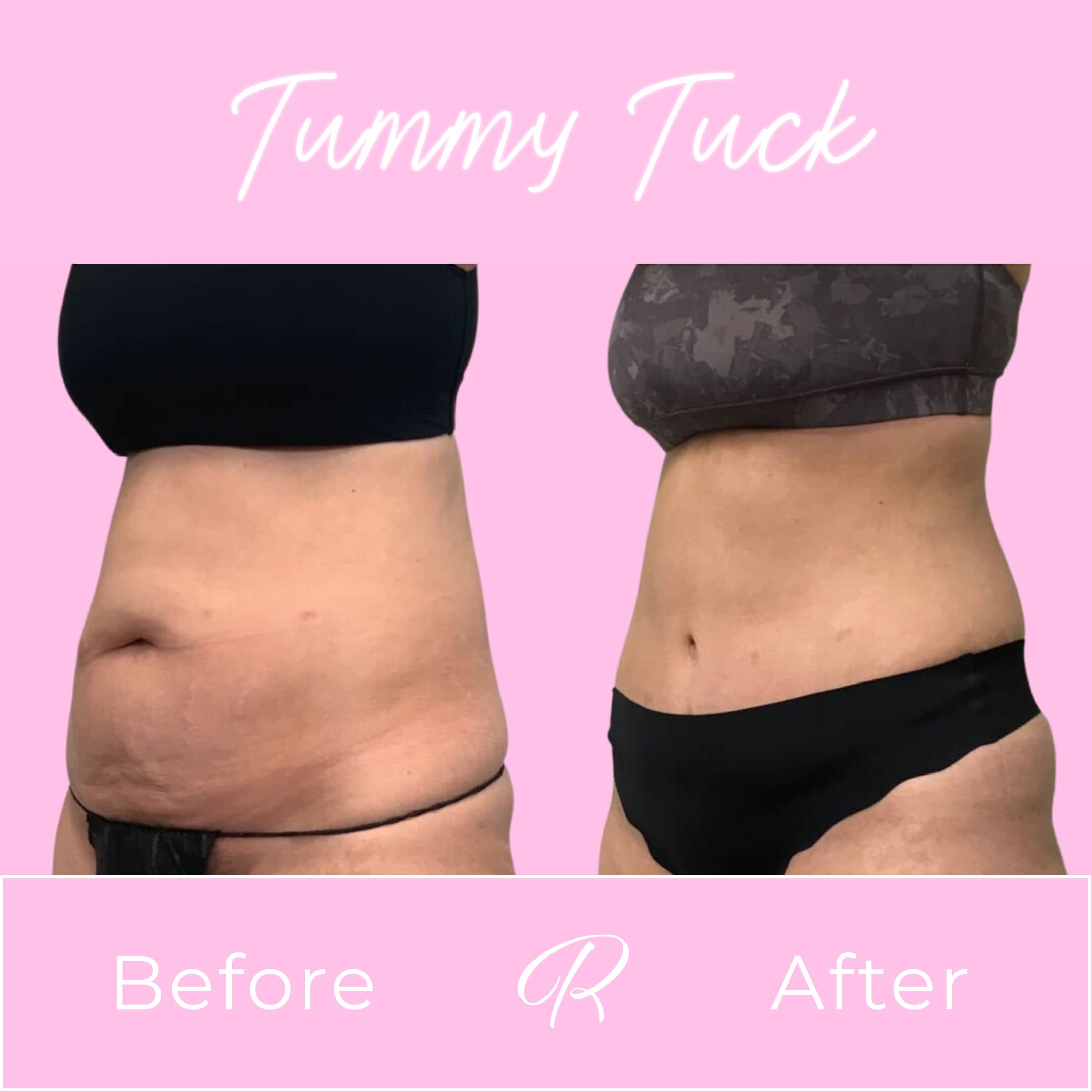 Tummy Tuck Before & After Gallery - Patient 13236 - Image 1