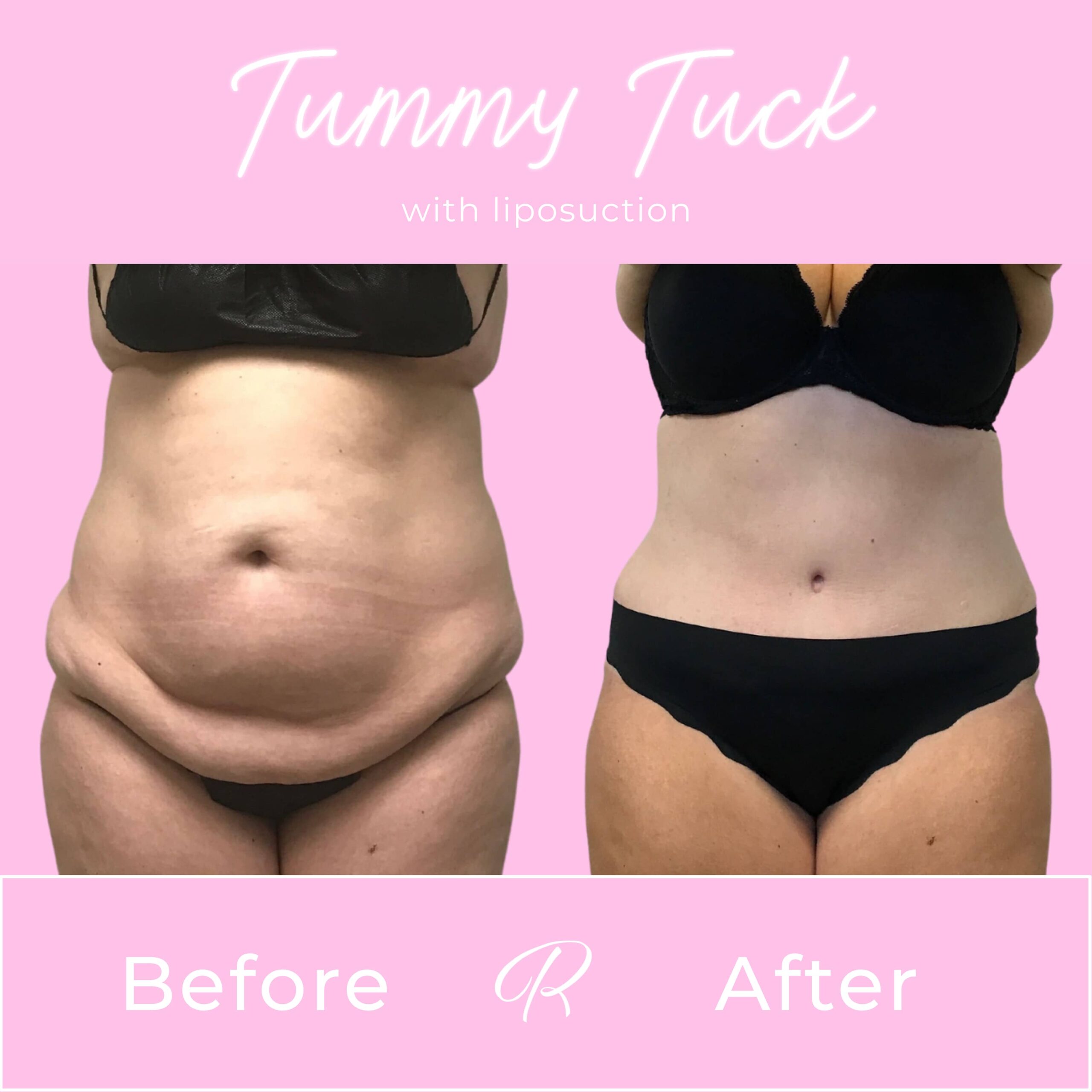 Tummy Tuck Before & After Gallery - Patient 13234 - Image 1