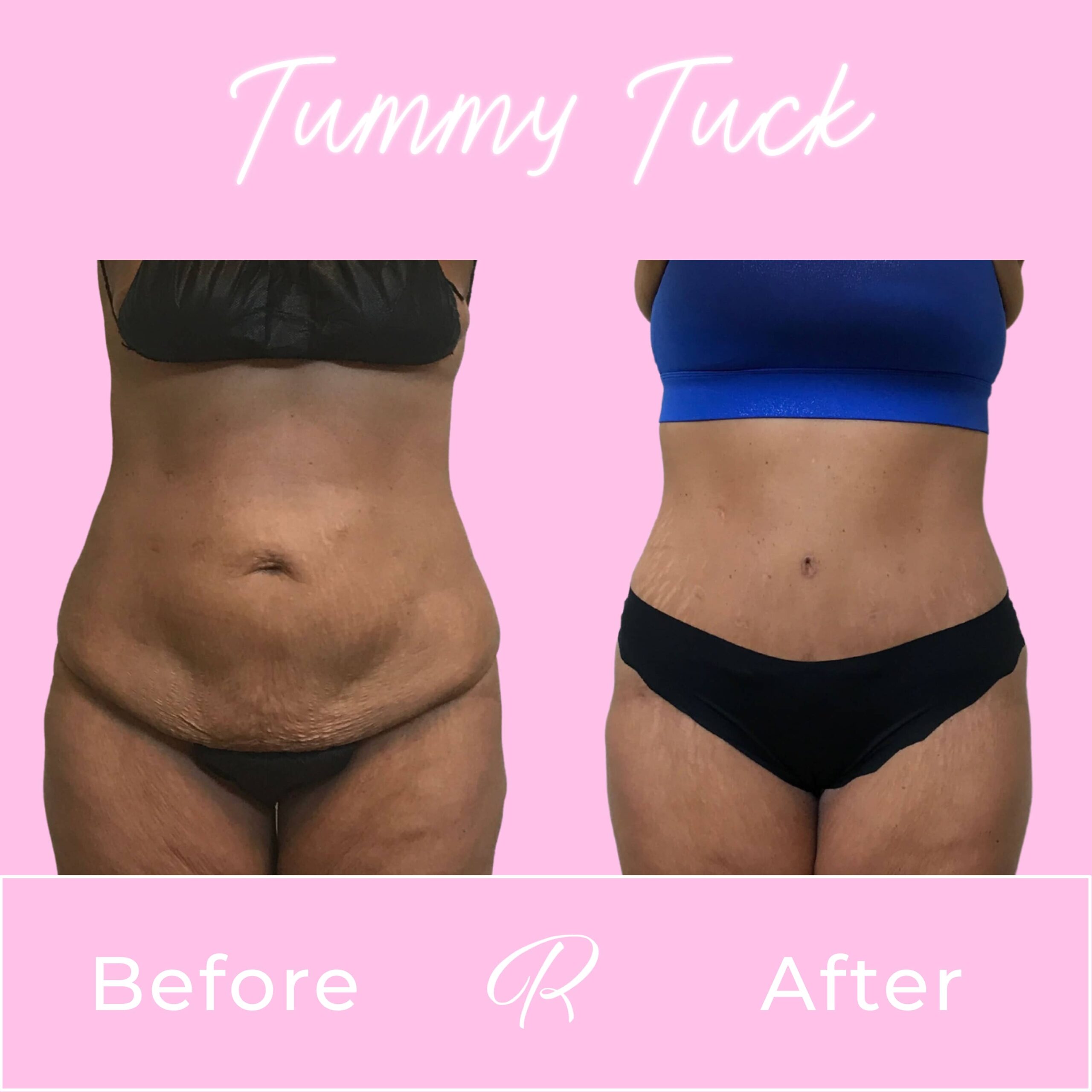 Tummy Tuck Before & After Gallery - Patient 13229 - Image 1