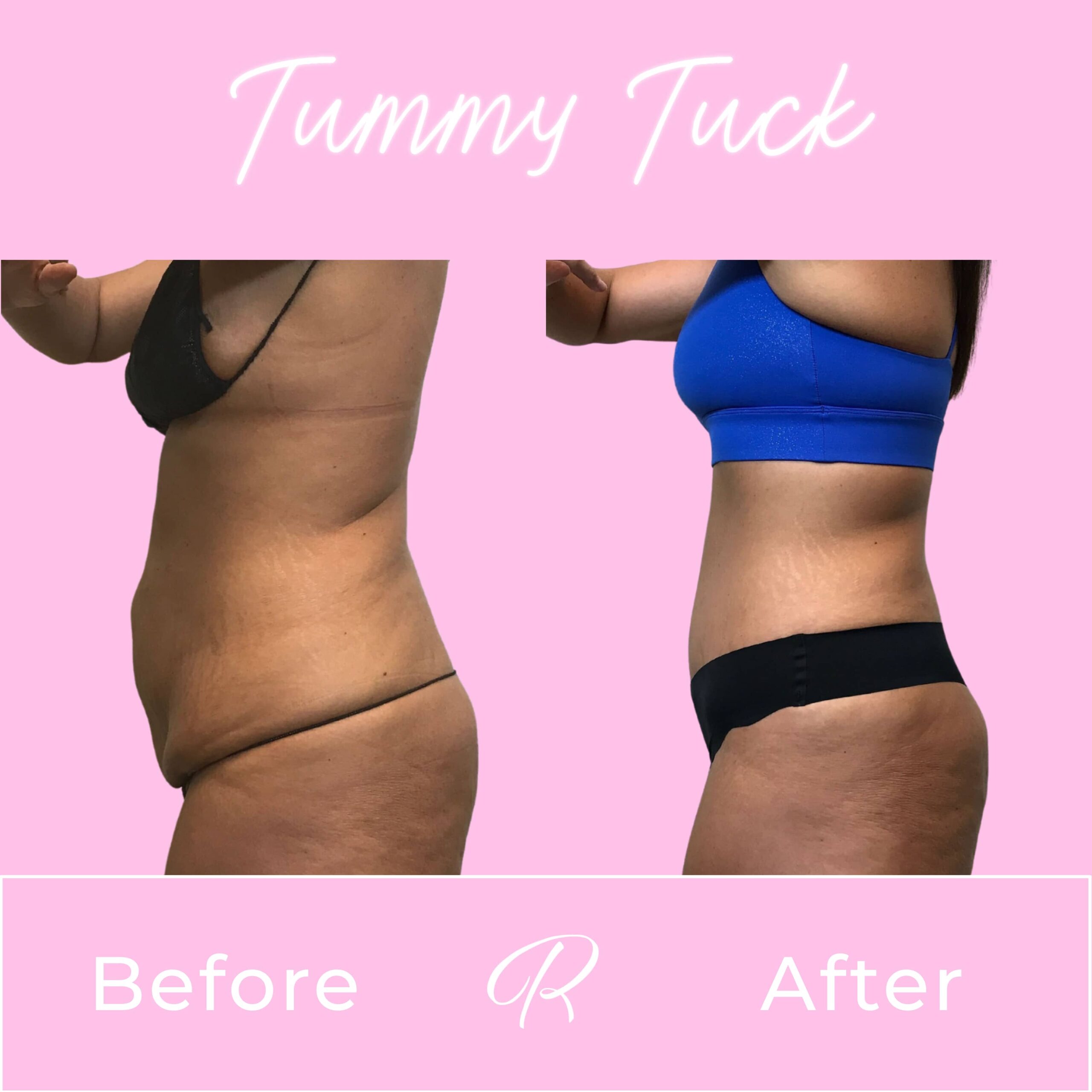Tummy Tuck Before & After Gallery - Patient 13229 - Image 2