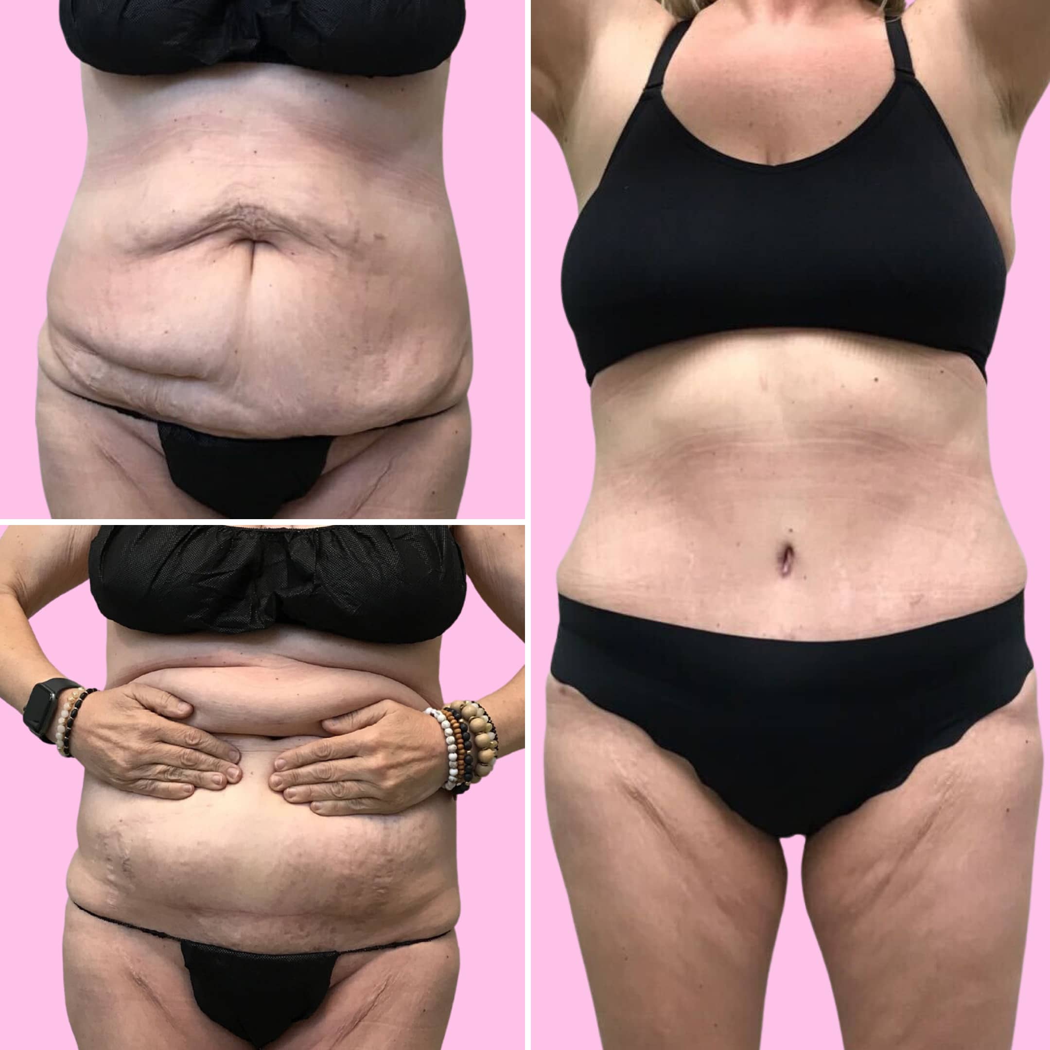 Tummy Tuck Before & After Gallery - Patient 13227 - Image 1