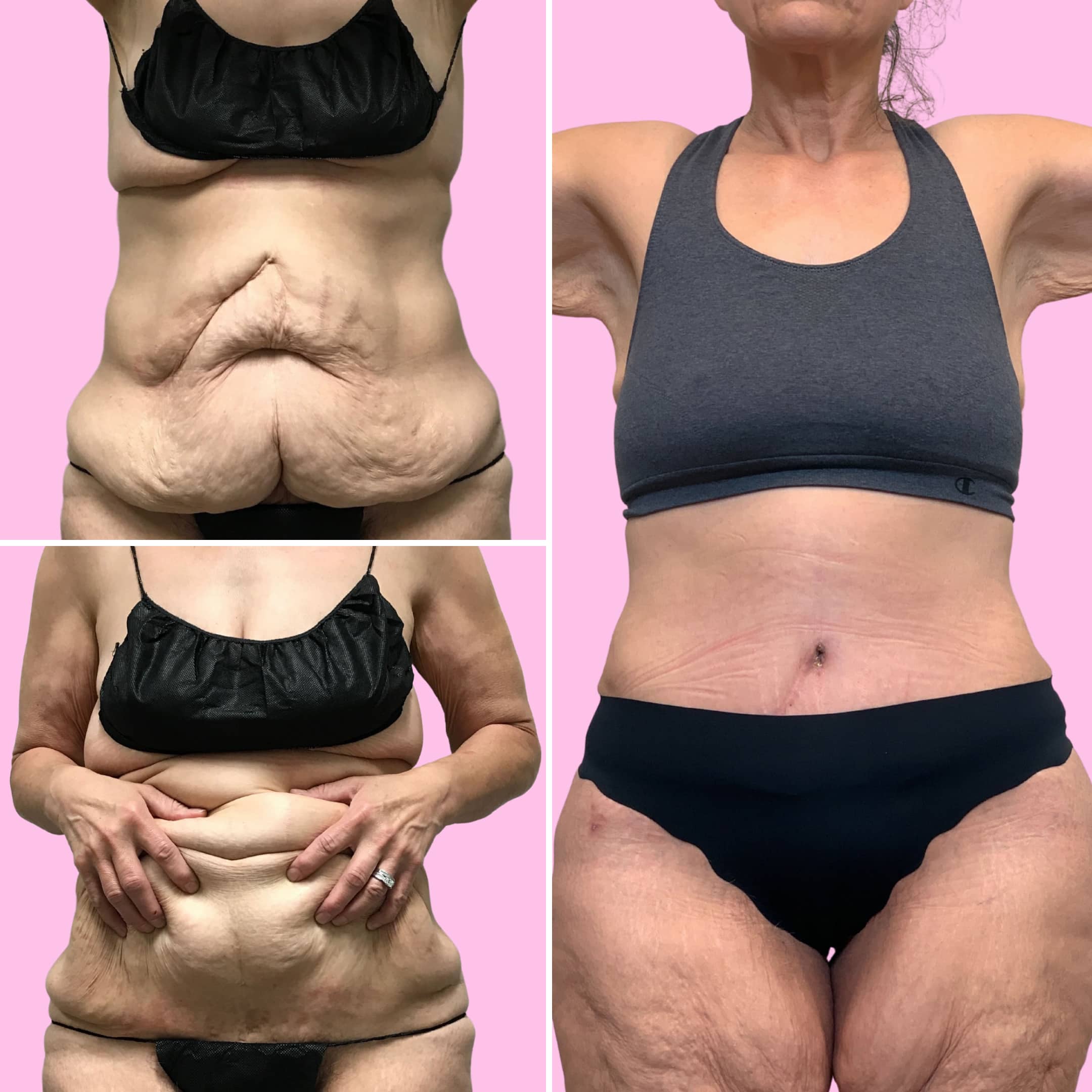 Tummy Tuck Before & After Gallery - Patient 13225 - Image 1