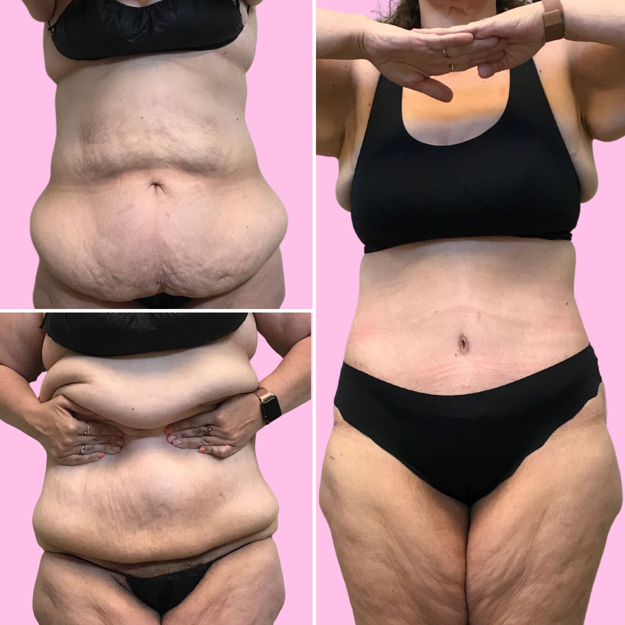Tummy Tuck Before & After Gallery - Patient 13222 - Image 1
