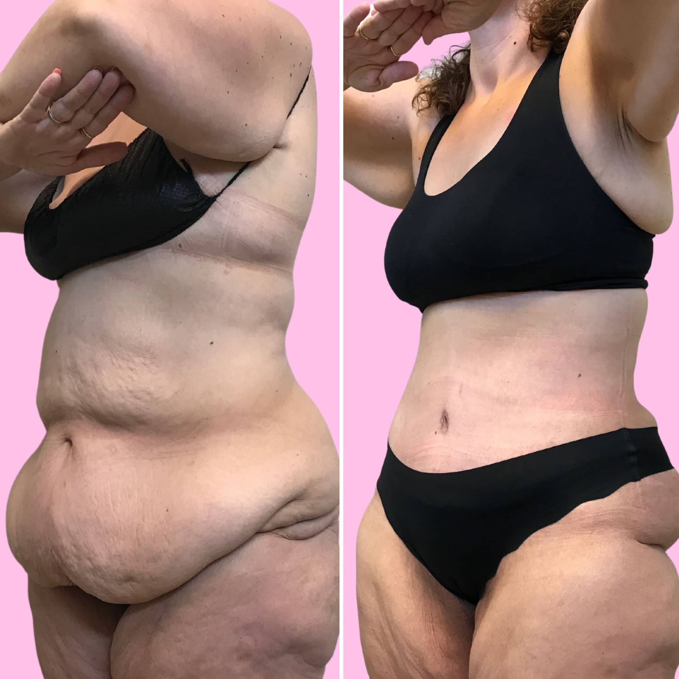 Tummy Tuck Before & After Gallery - Patient 13222 - Image 2