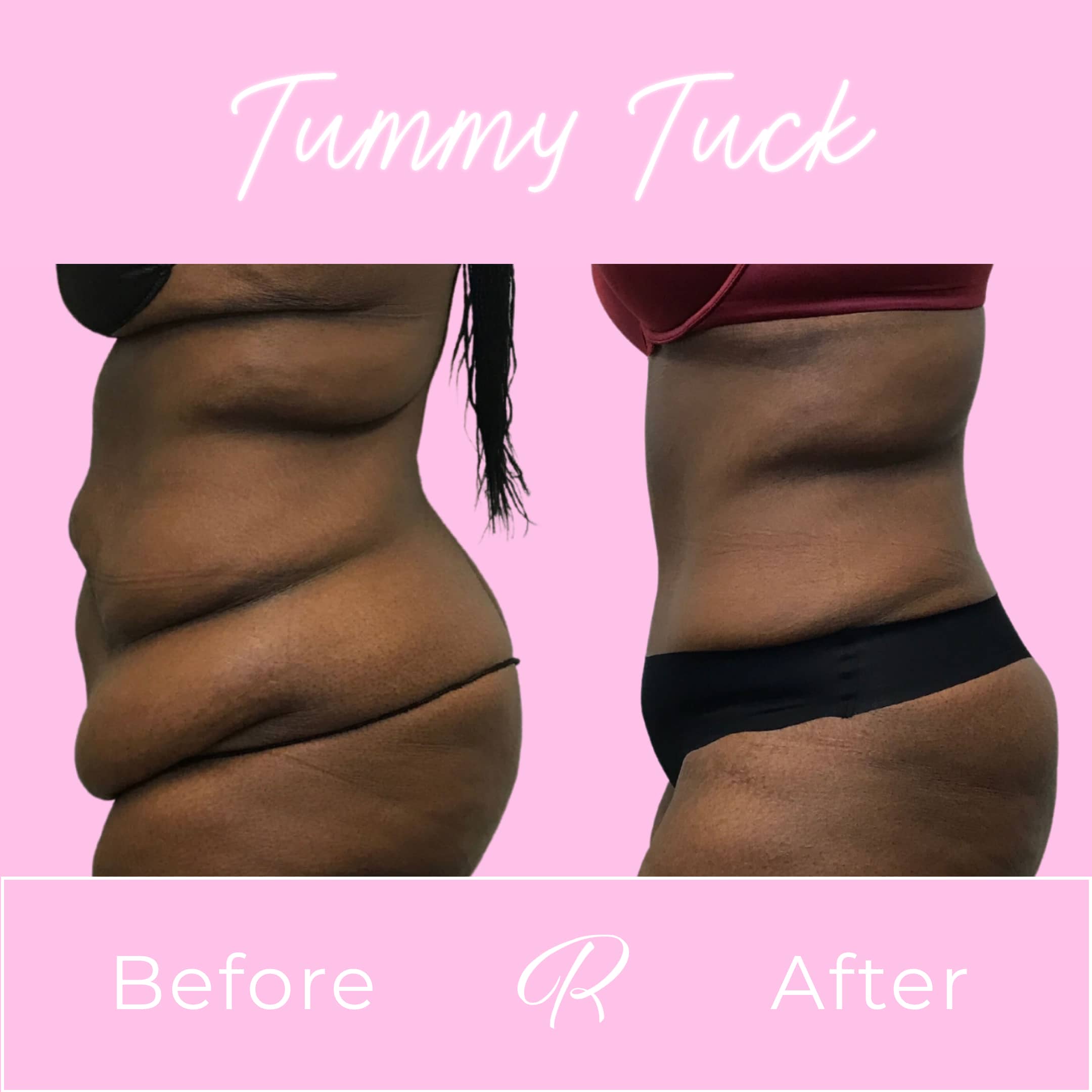 Tummy Tuck Before & After Gallery - Patient 13219 - Image 2