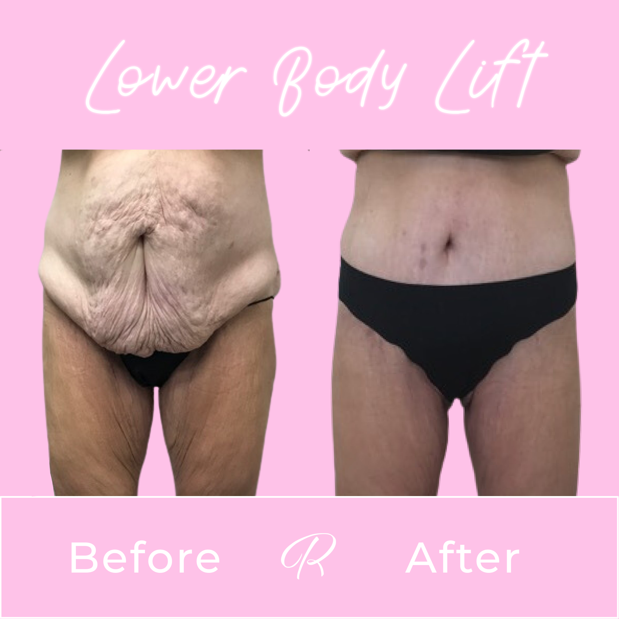 Lower Body Lift Before & After Gallery - Patient 13382 - Image 1