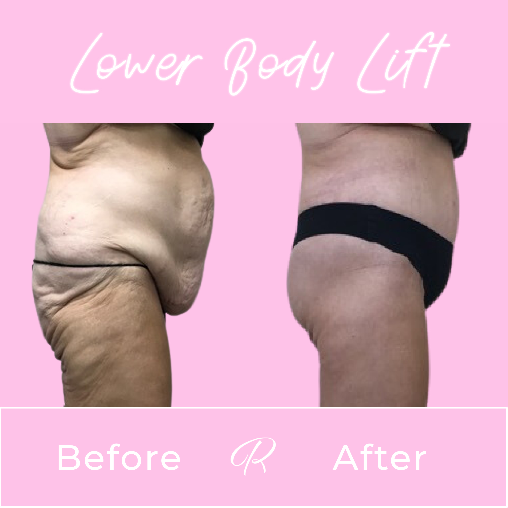 Lower Body Lift Before & After Gallery - Patient 13382 - Image 2