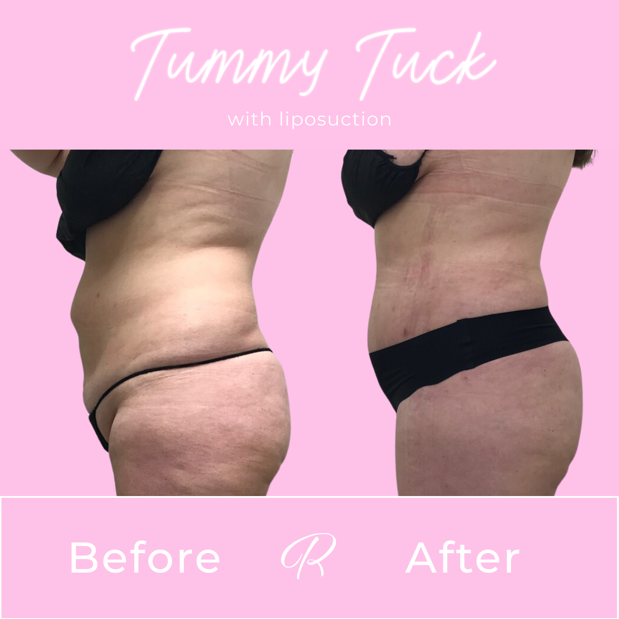 Tummy Tuck Before & After Gallery - Patient 13260 - Image 4