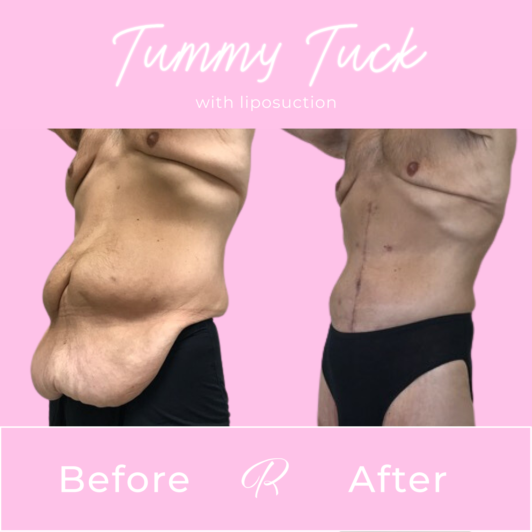 Tummy Tuck Before & After Gallery - Patient 13258 - Image 3