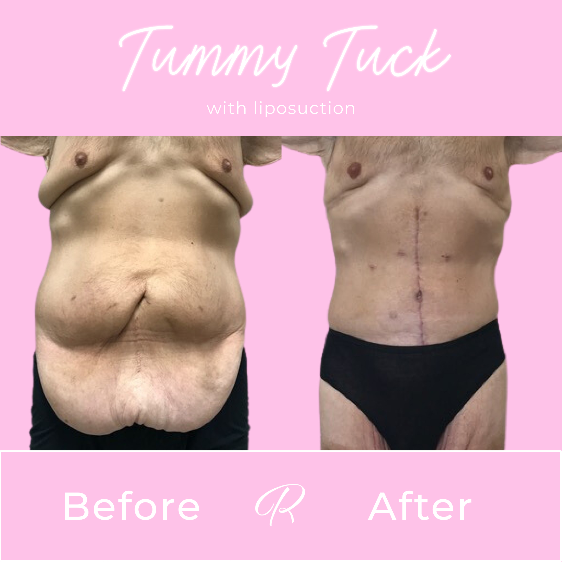 Tummy Tuck Before & After Gallery - Patient 13258 - Image 1