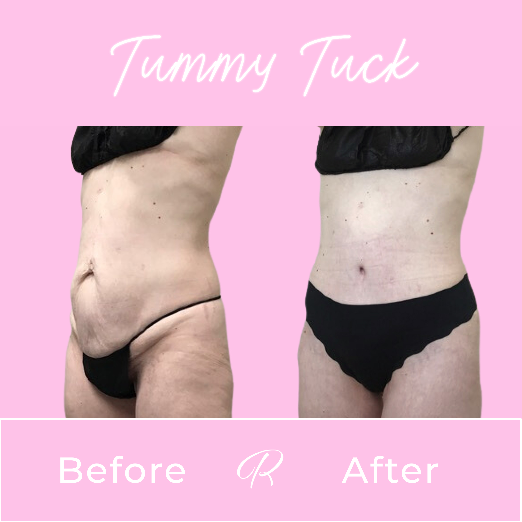 Tummy Tuck Before & After Gallery - Patient 13259 - Image 2