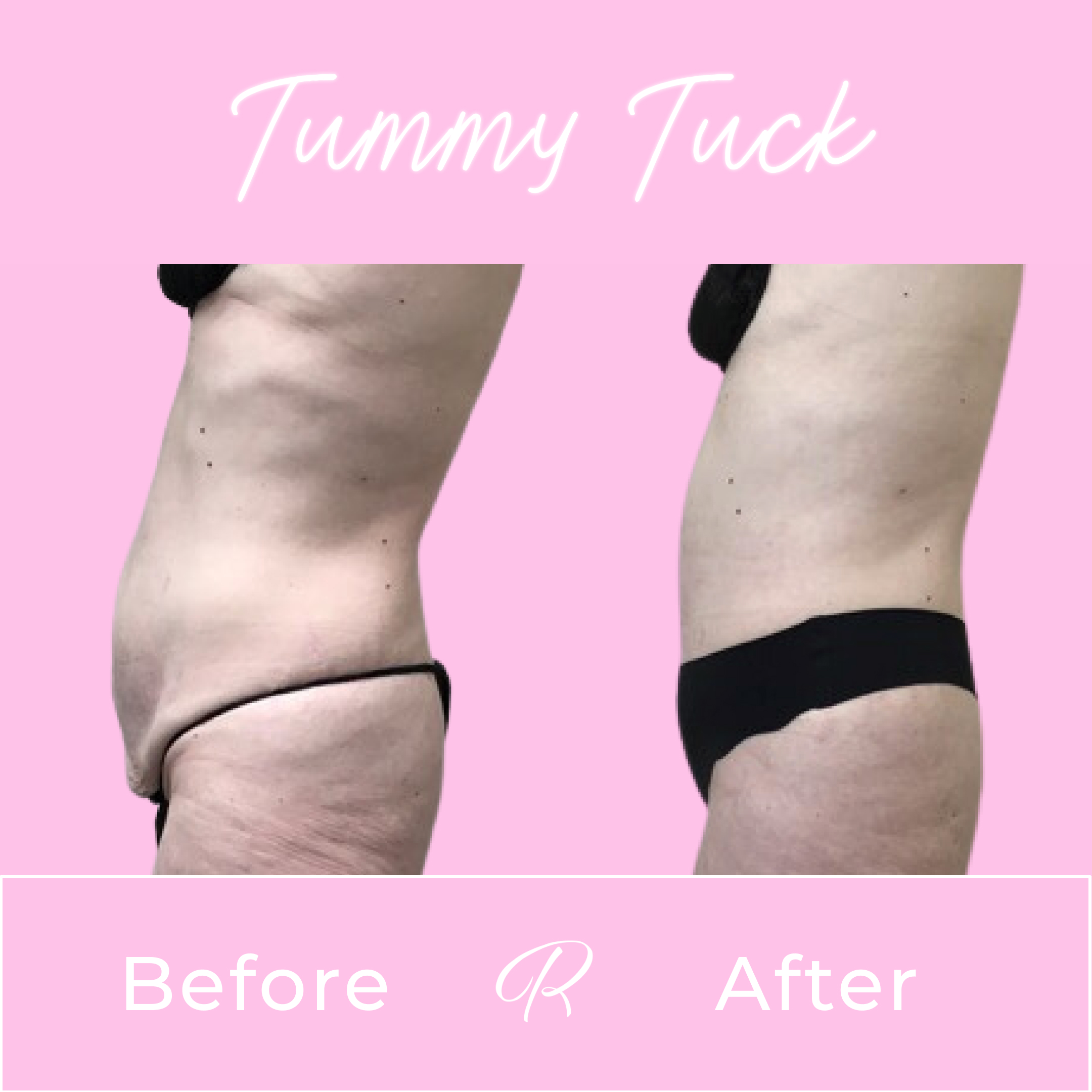Tummy Tuck Before & After Gallery - Patient 13259 - Image 4