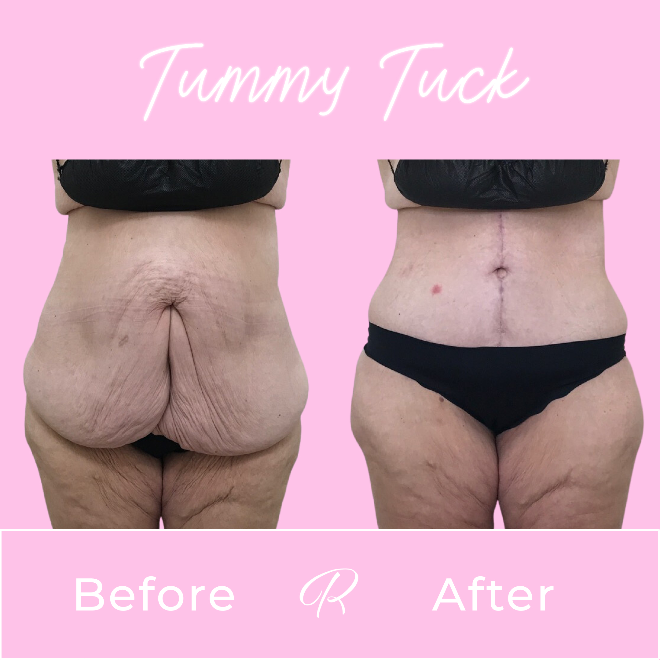 Tummy Tuck Before & After Gallery - Patient 13265 - Image 1