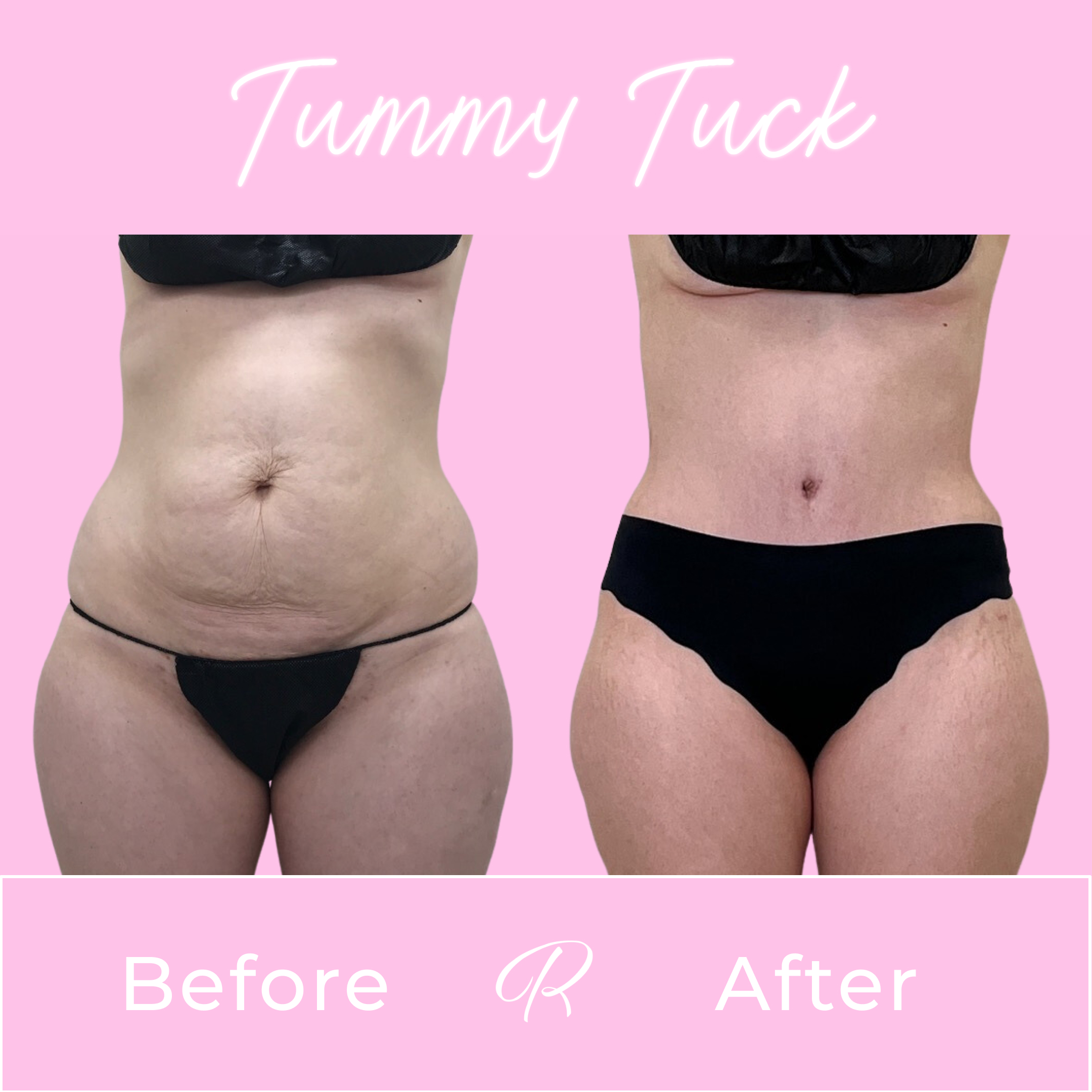 Tummy Tuck Before & After Gallery - Patient 13274 - Image 1