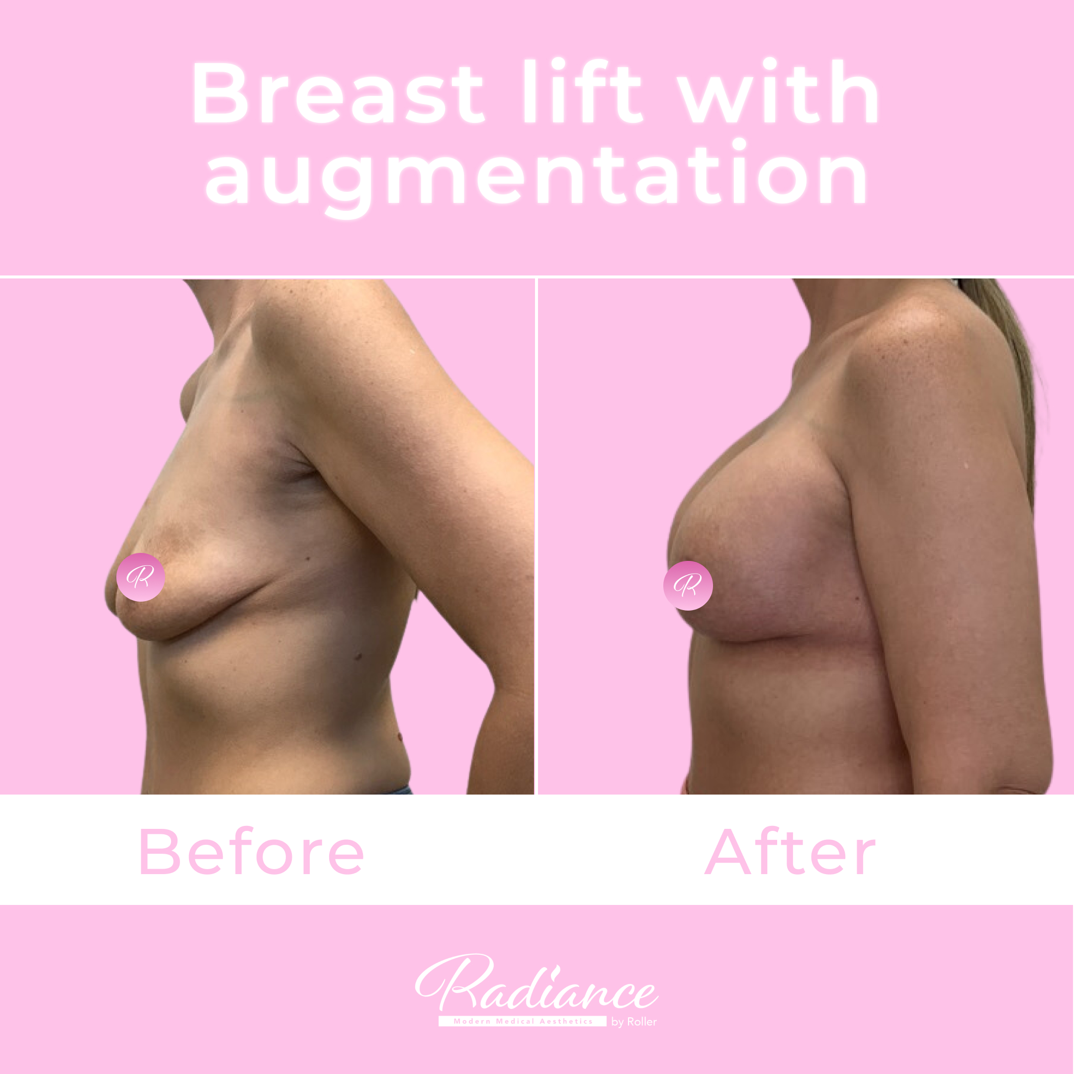 Breast Lift With Augmentation Before & After Gallery - Patient 13424 - Image 3