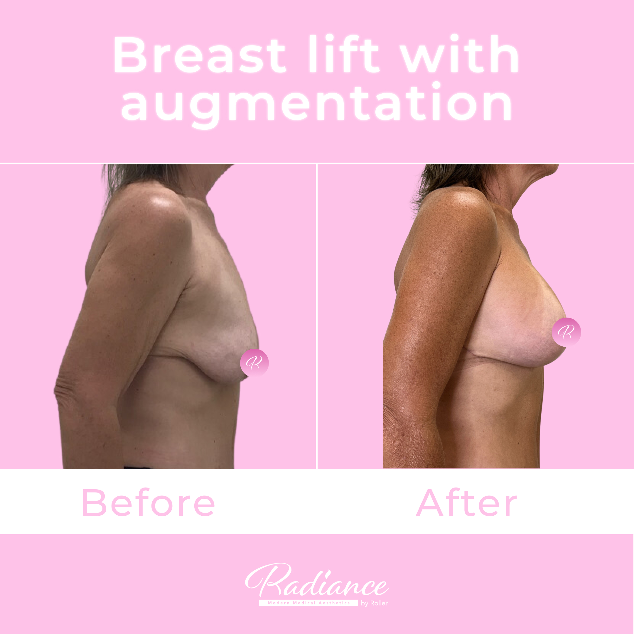 Breast Lift With Augmentation Before & After Gallery - Patient 13425 - Image 5