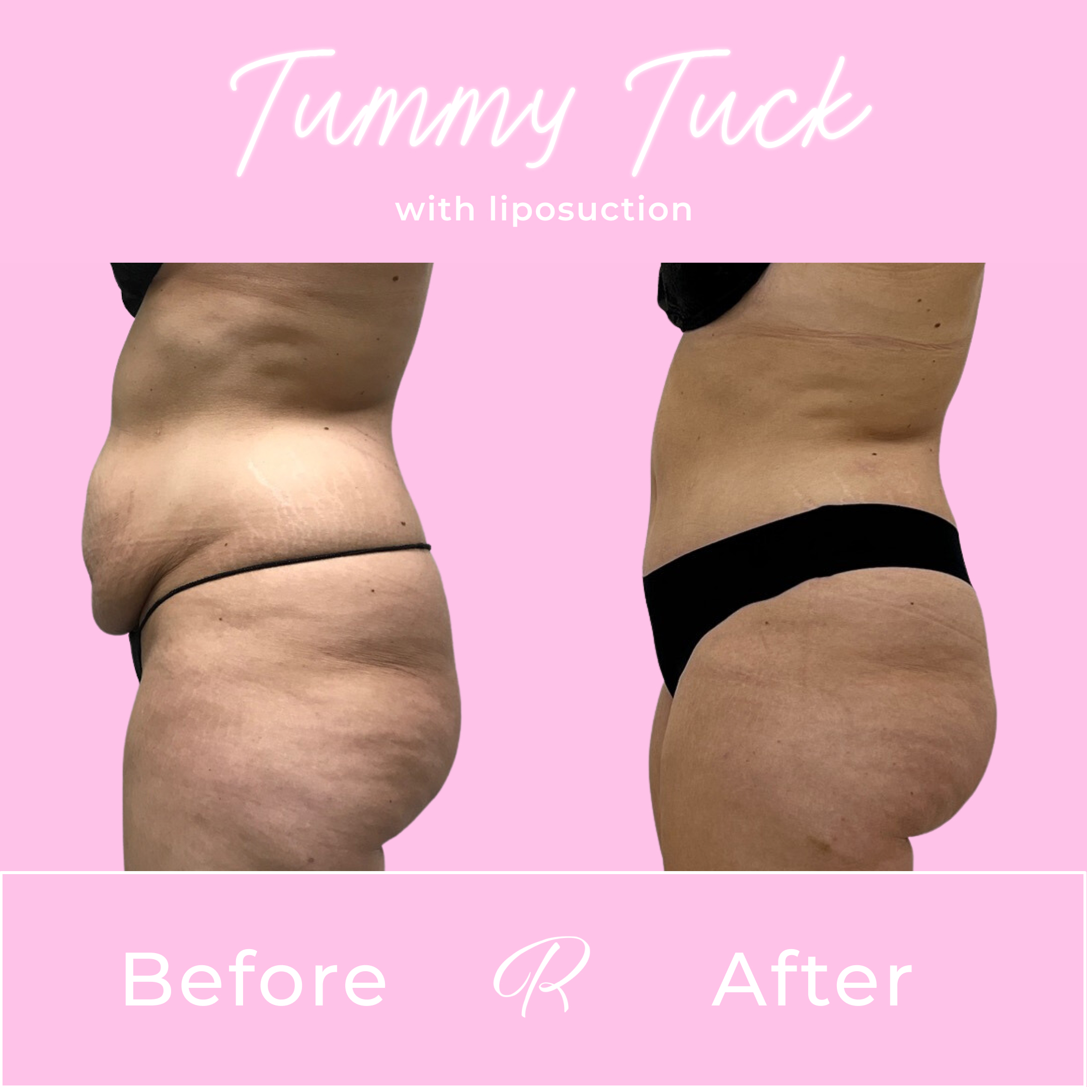 Tummy Tuck Before & After Gallery - Patient 13281 - Image 4