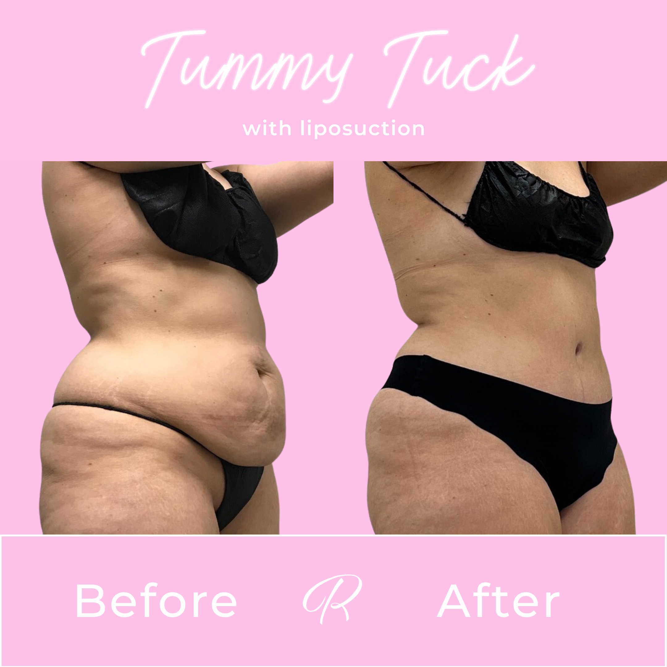 Tummy Tuck Before & After Gallery - Patient 13281 - Image 2