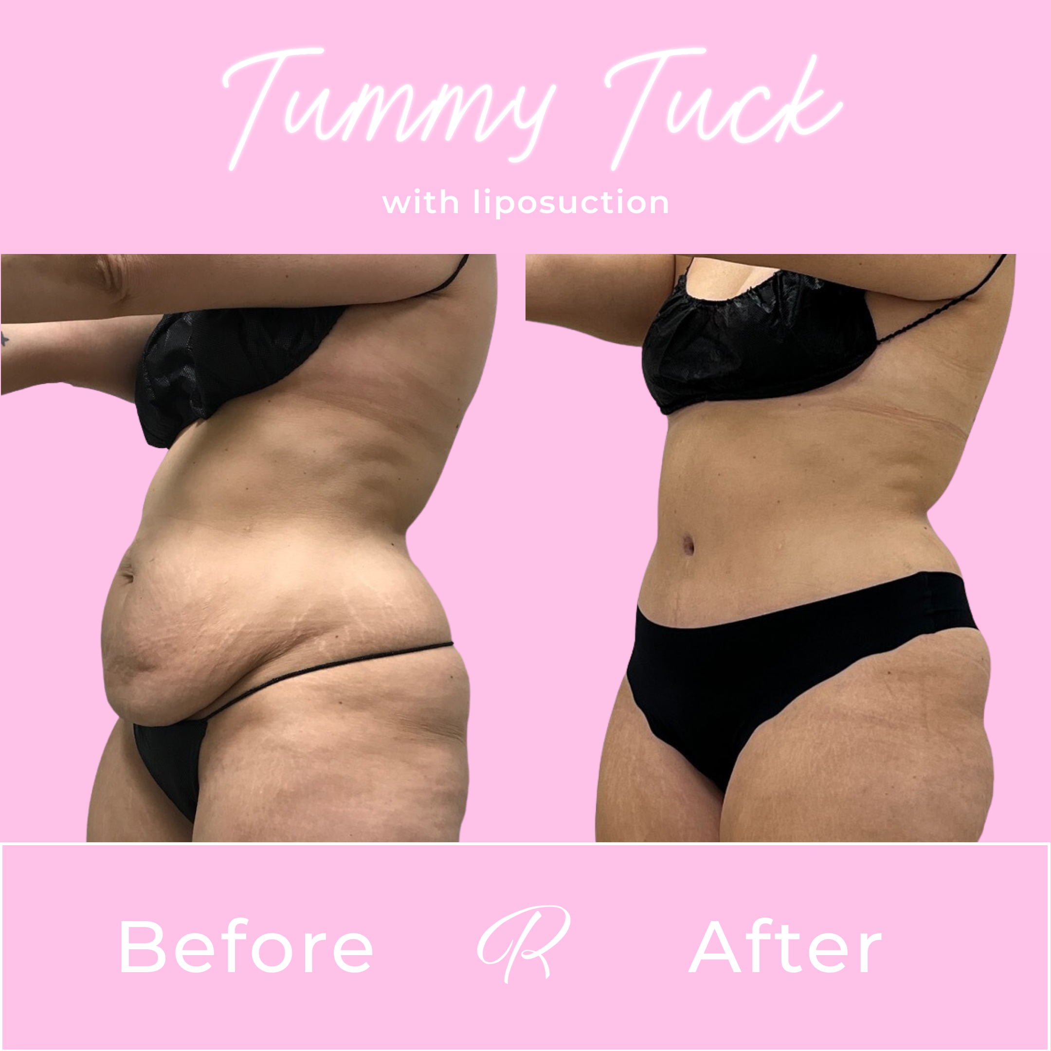 Tummy Tuck Before & After Gallery - Patient 13281 - Image 3