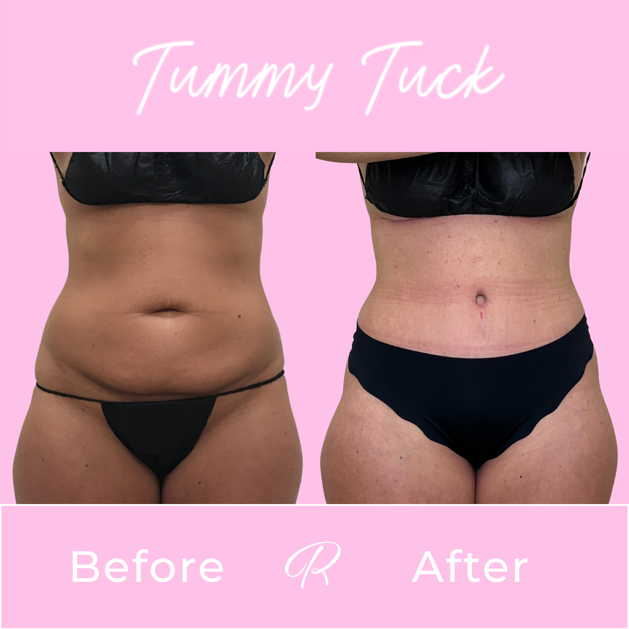 Tummy Tuck Before & After Gallery - Patient 13314 - Image 1