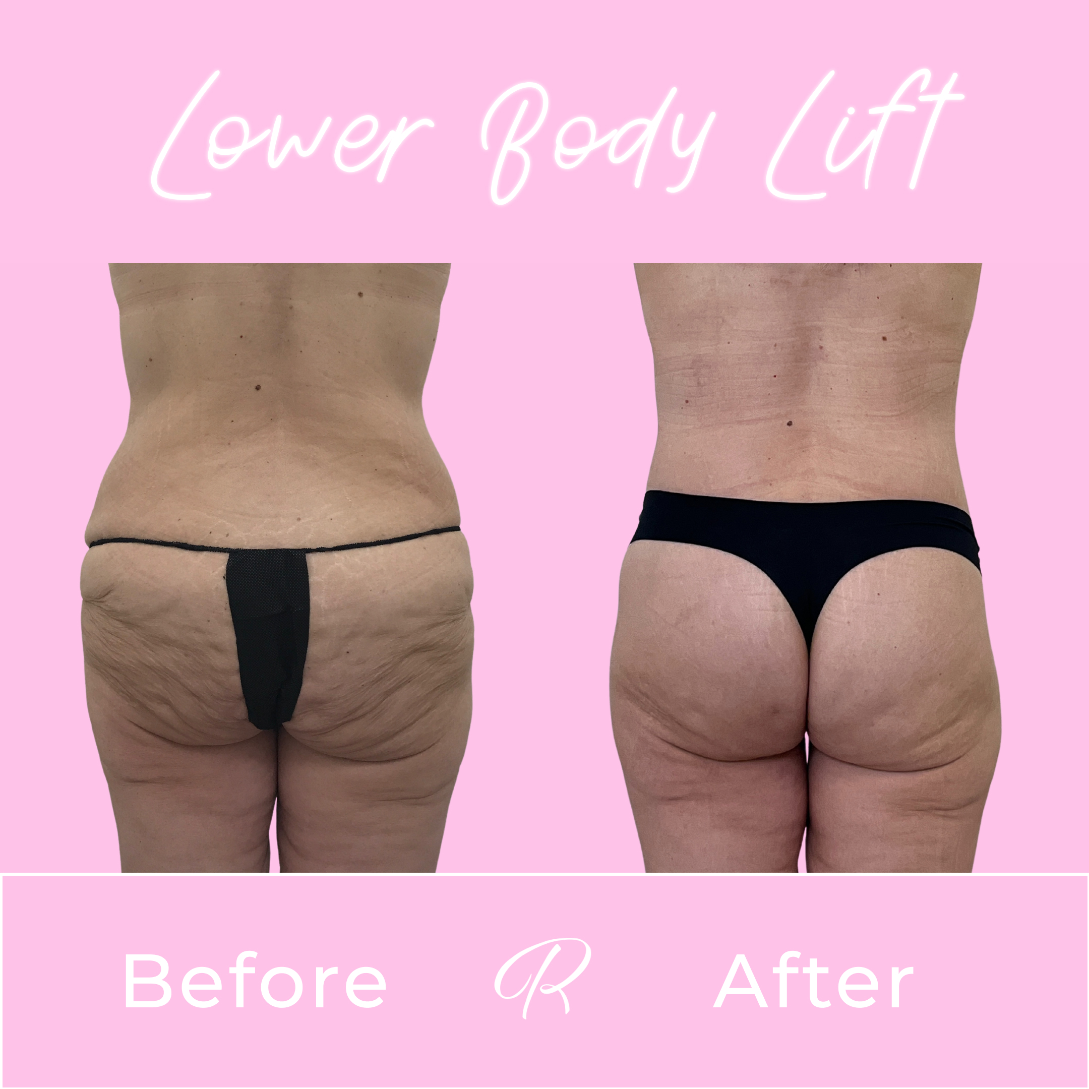 Lower Body Lift Before & After Gallery - Patient 13384 - Image 4