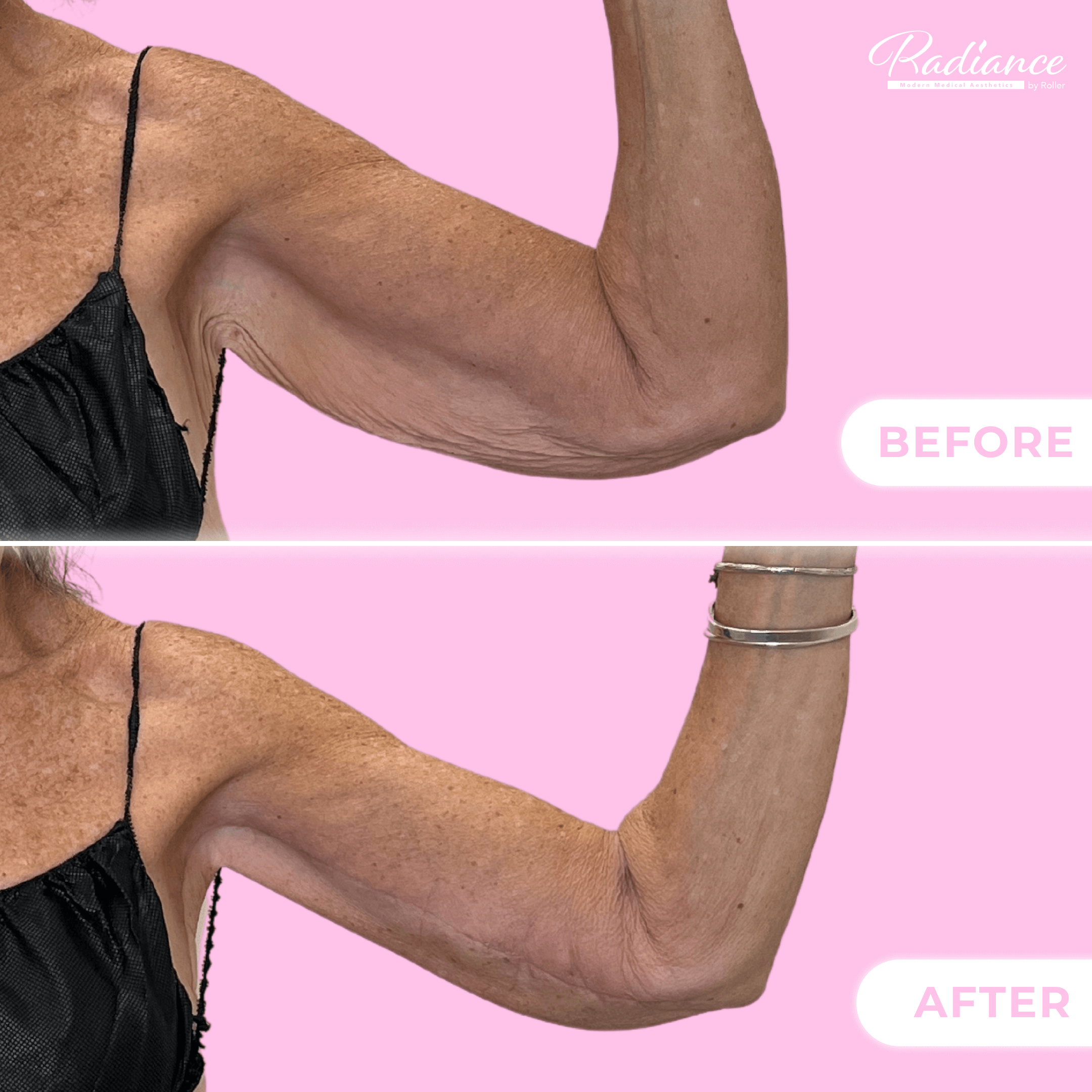 Arm Lift Before & After Gallery - Patient 13439 - Image 1