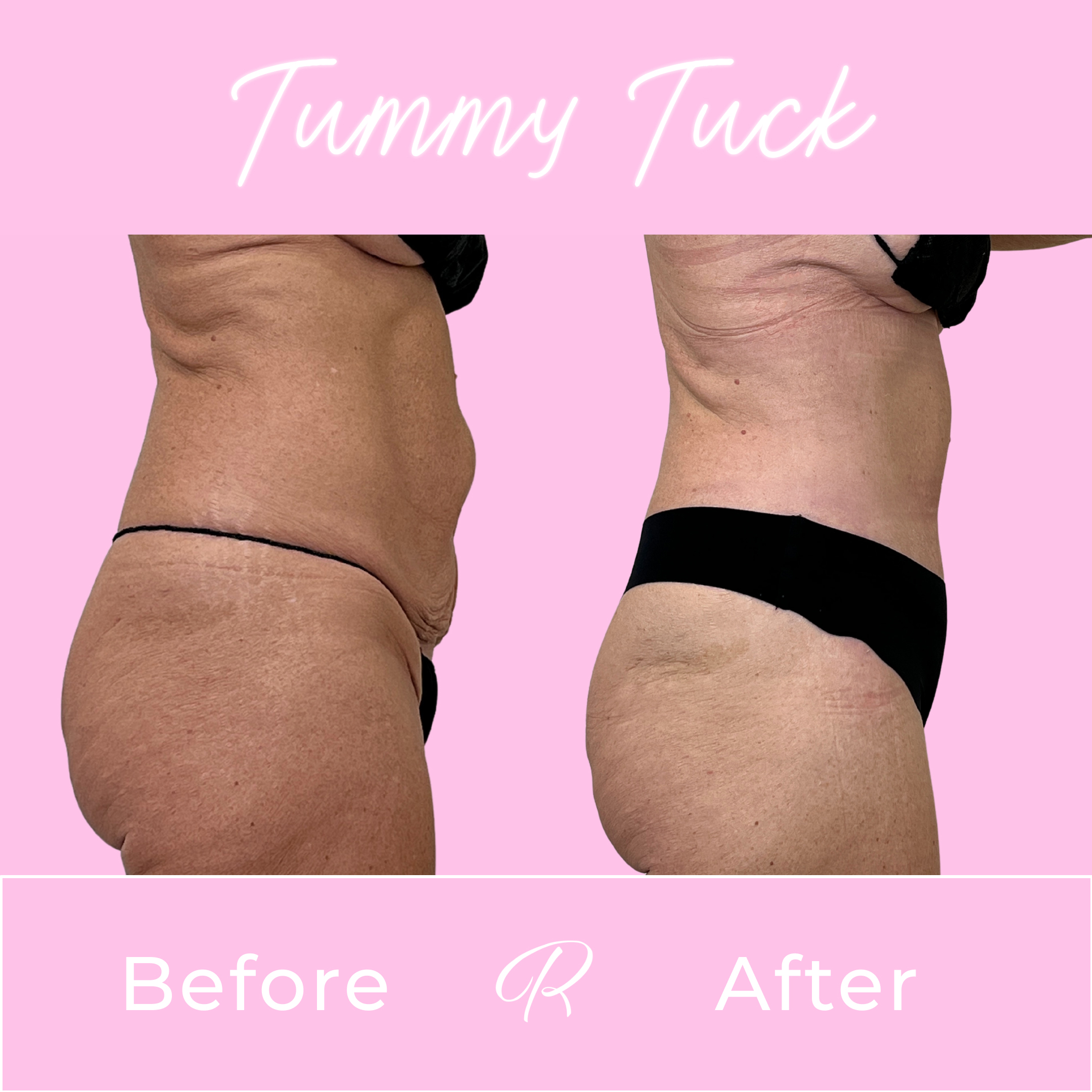 Tummy Tuck Before & After Gallery - Patient 13318 - Image 3
