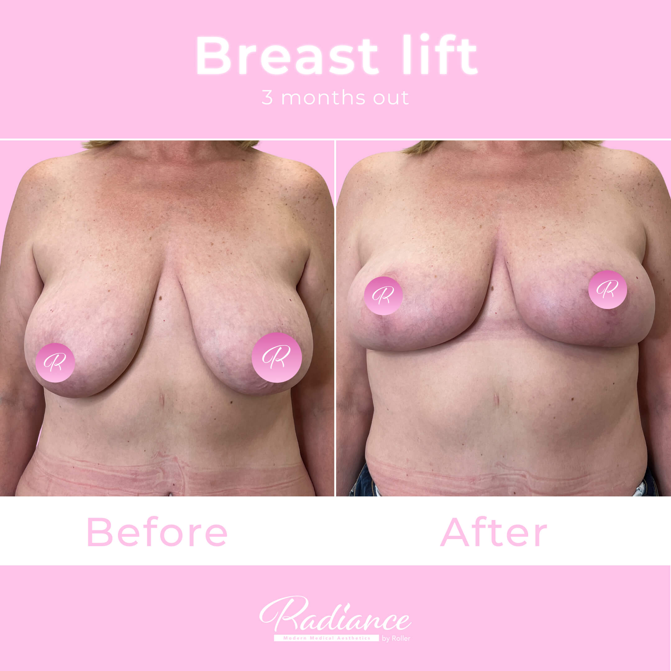 Breast Lift Before & After Gallery - Patient 13410 - Image 3